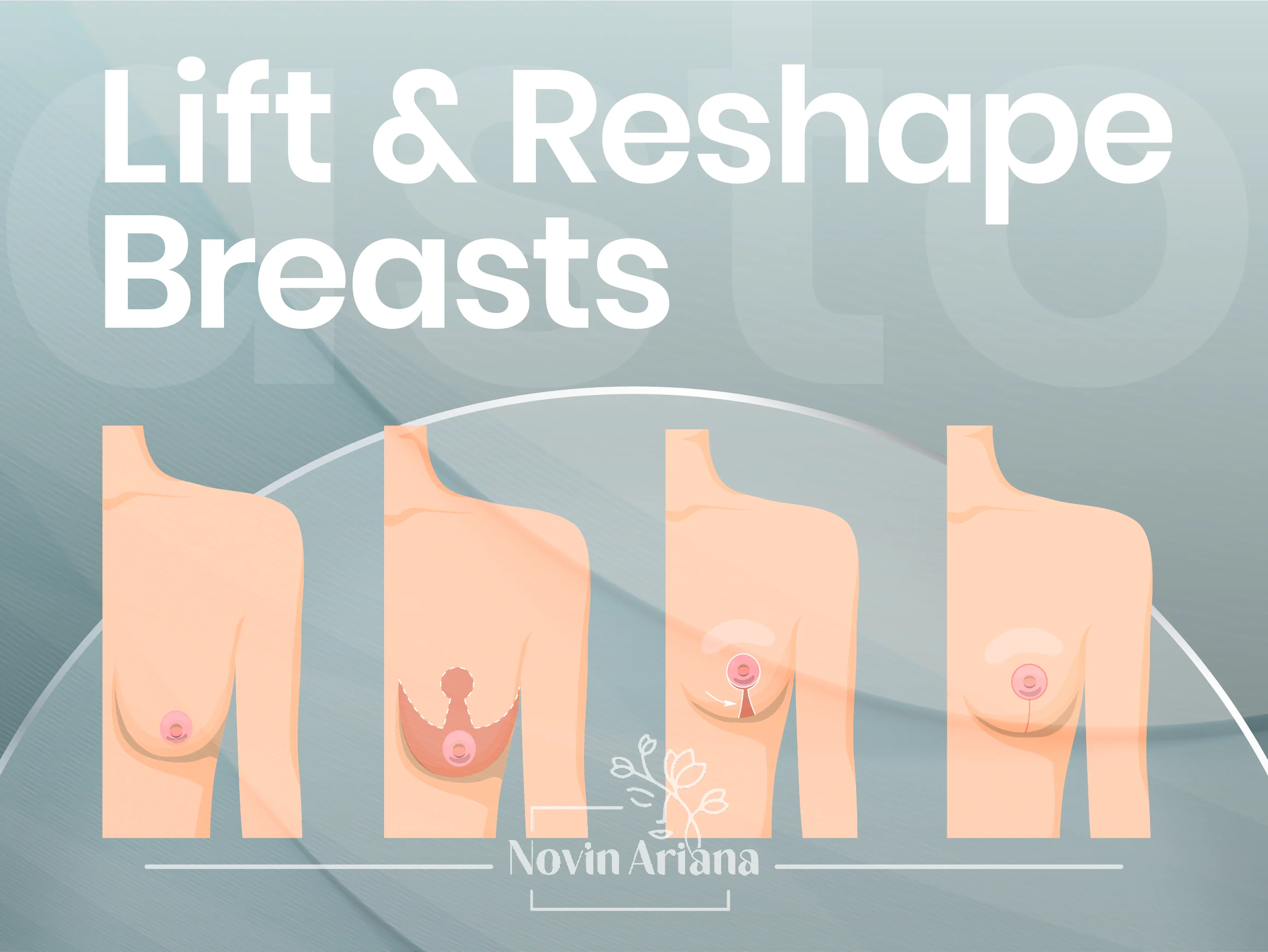 BreastLift 02 OP