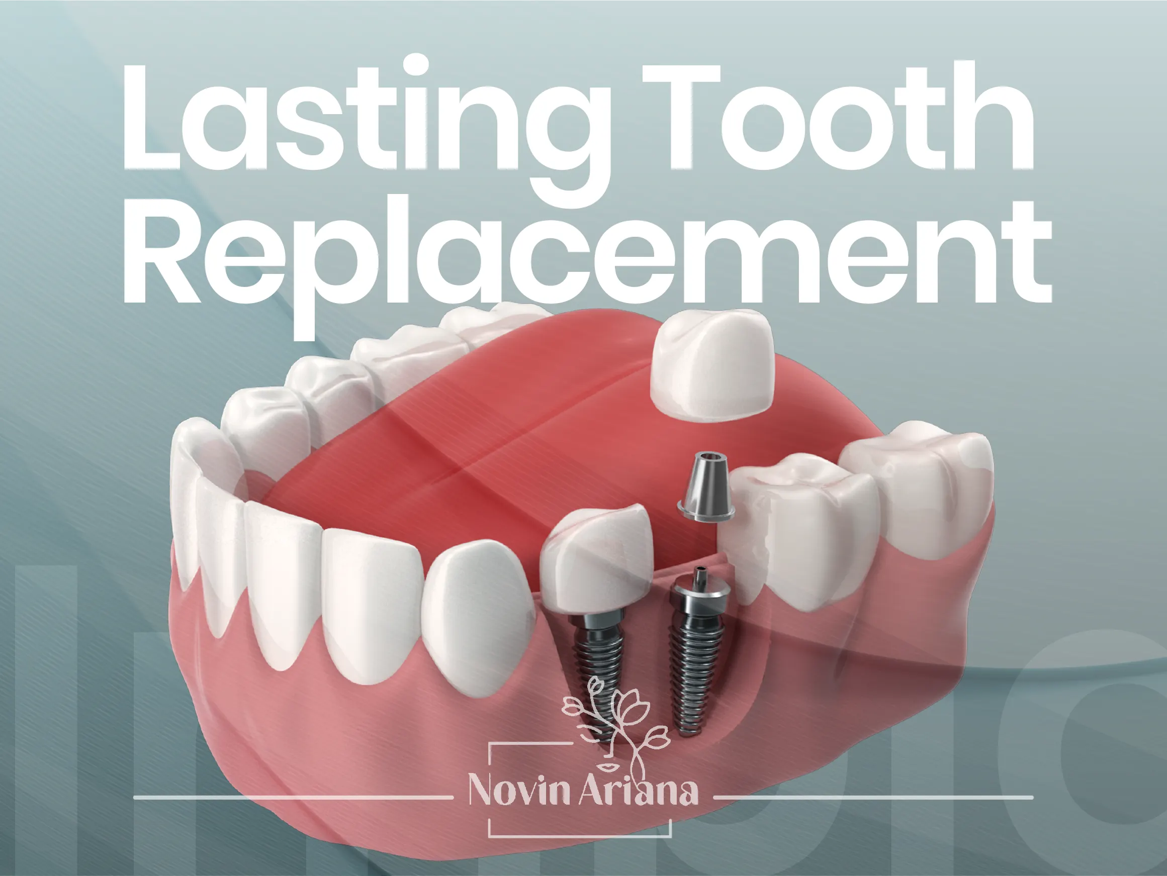 Full Dental Implants