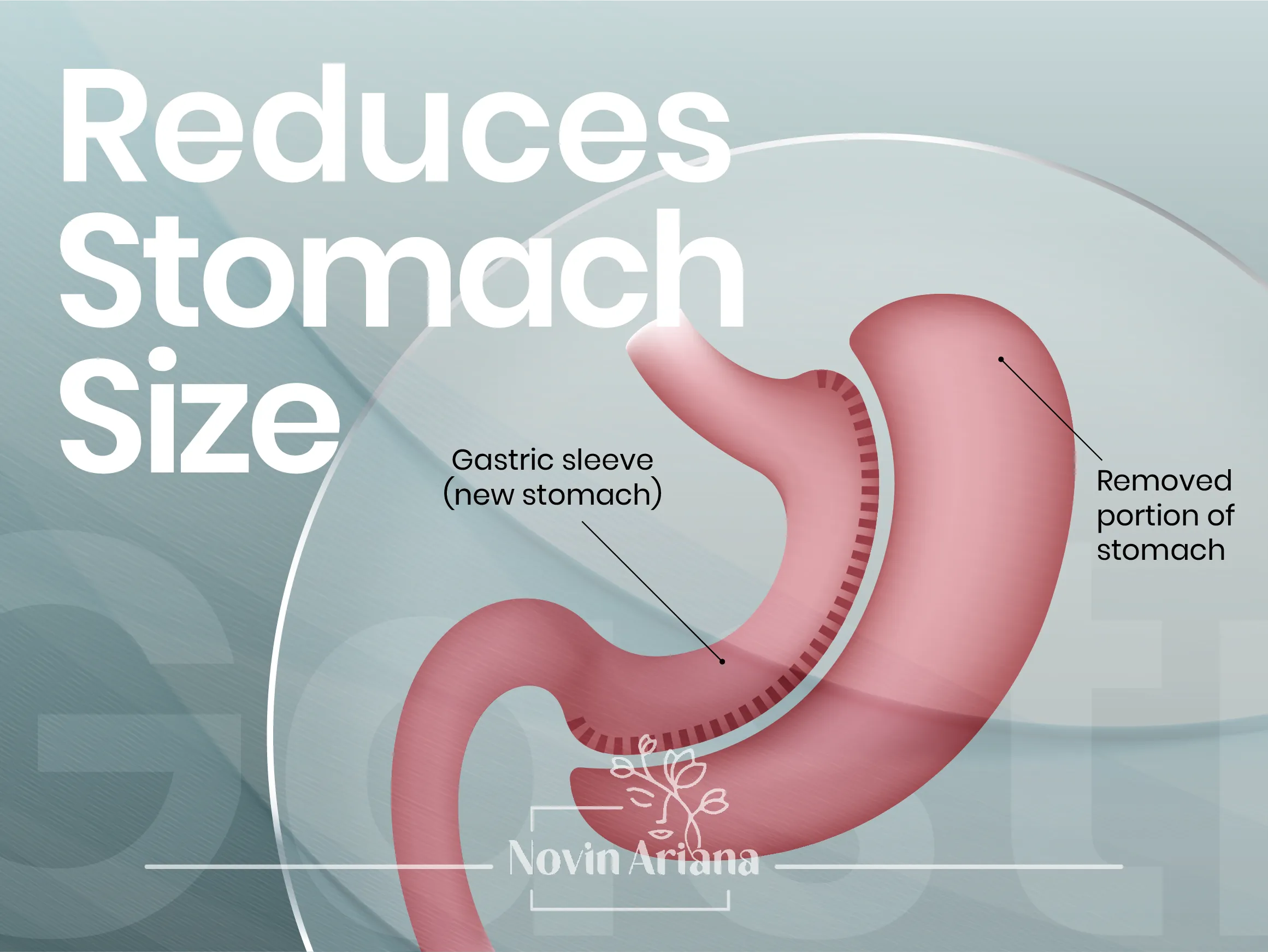 GastricSleeveSurgery 02 OP