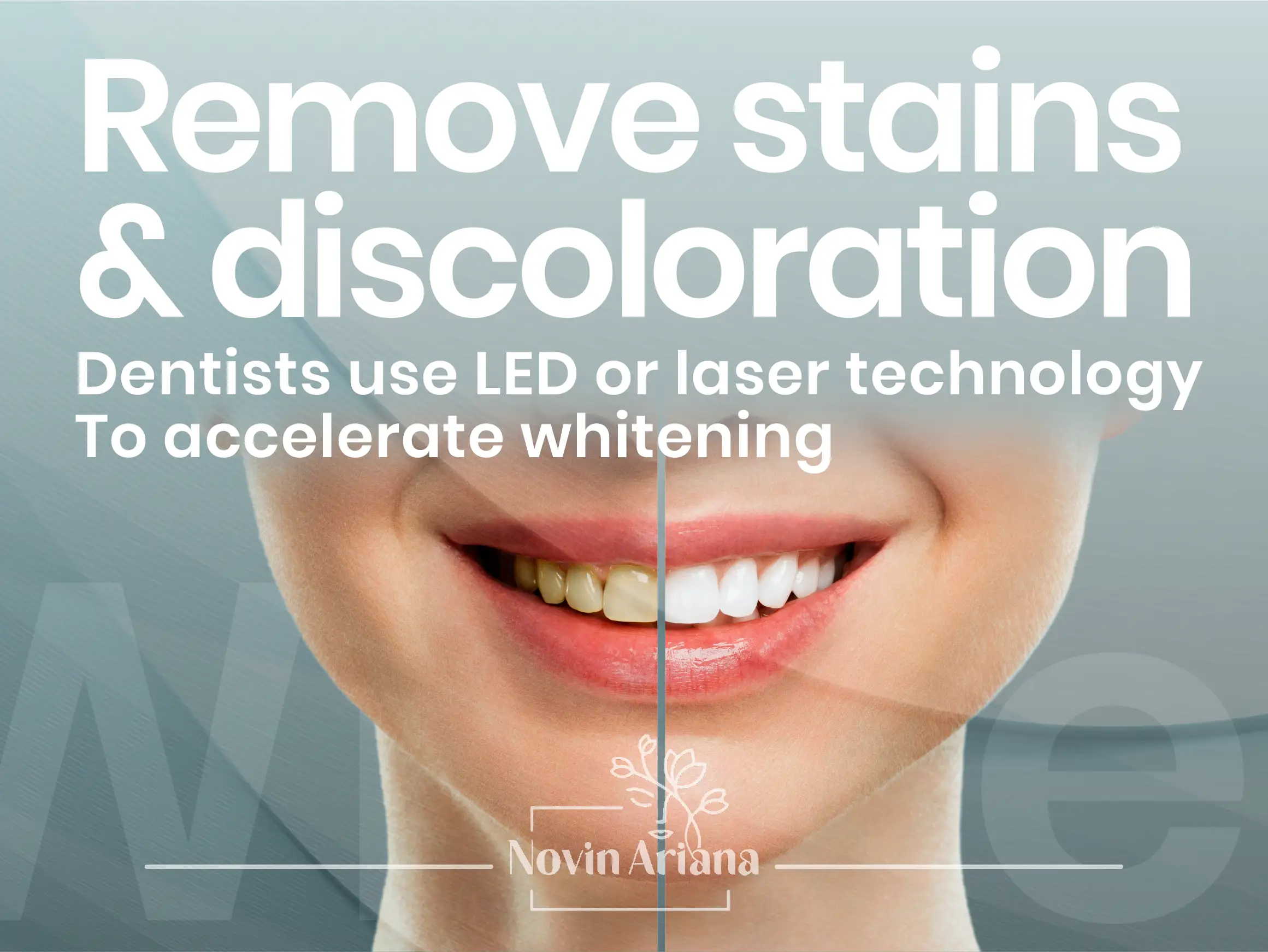 TeethWhitening 02 OP