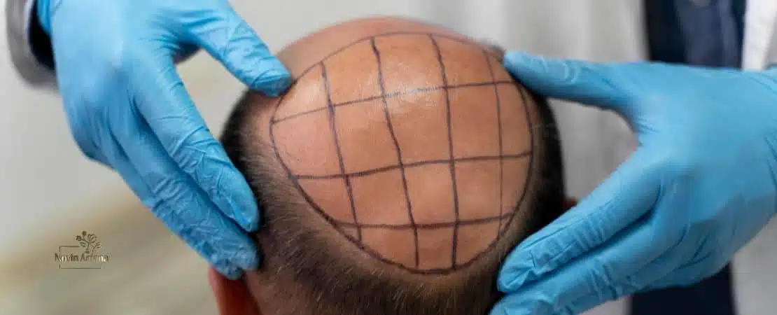 ده باور غلط درباره کاشت مو که باید فراموششان کنید