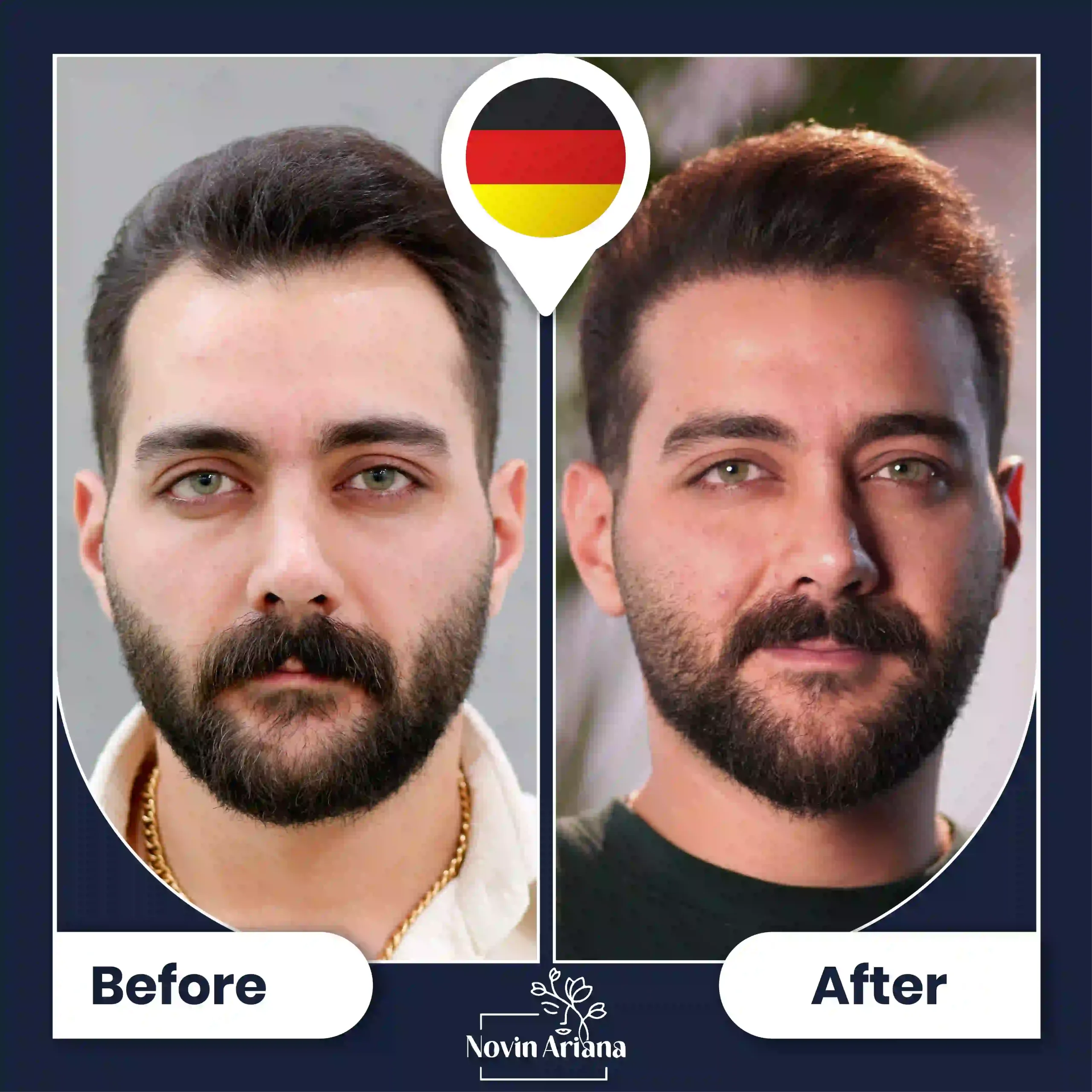 B-A-HairTransplant-01-OP