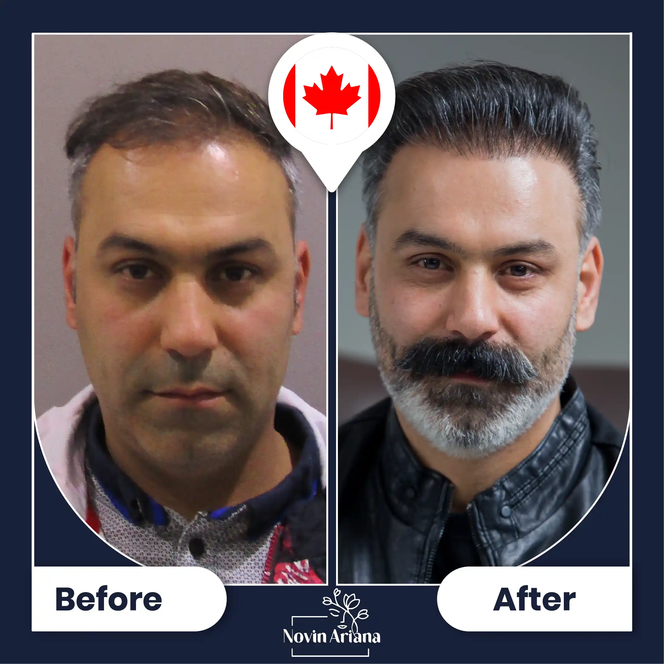 B-A-HairTransplant-30-OP