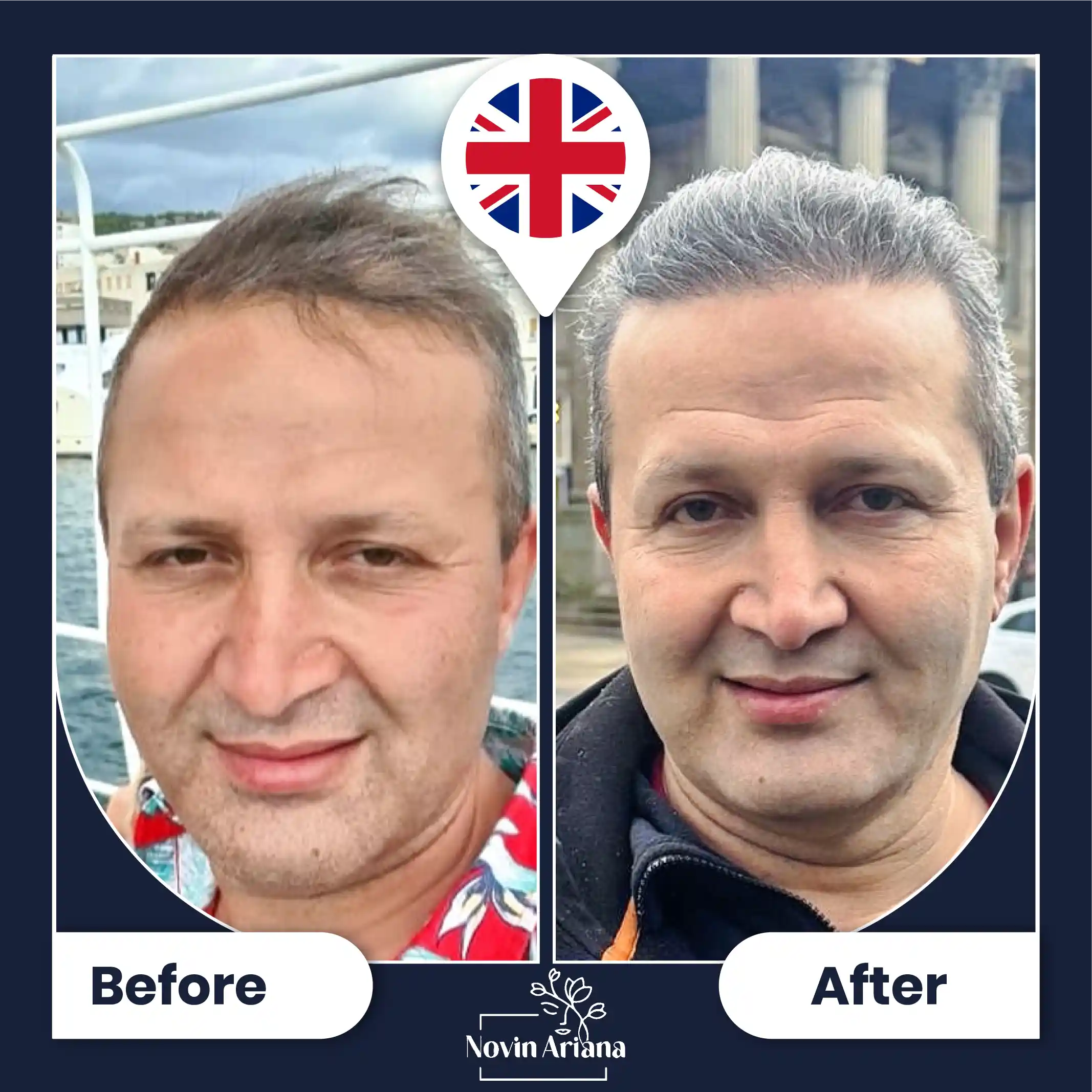 B-A-HairTransplant-36-OP