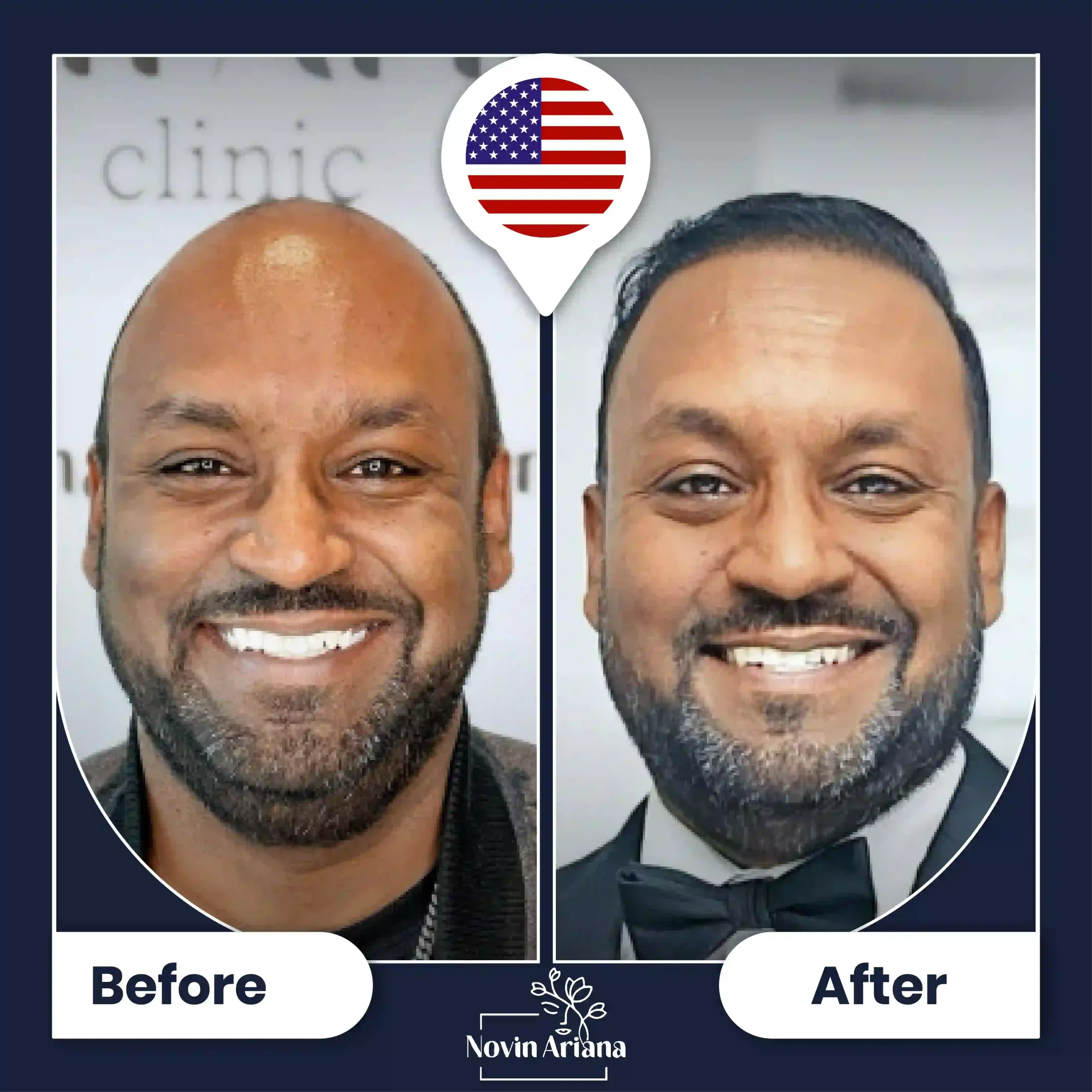 B-A-HairTransplant-41-OP