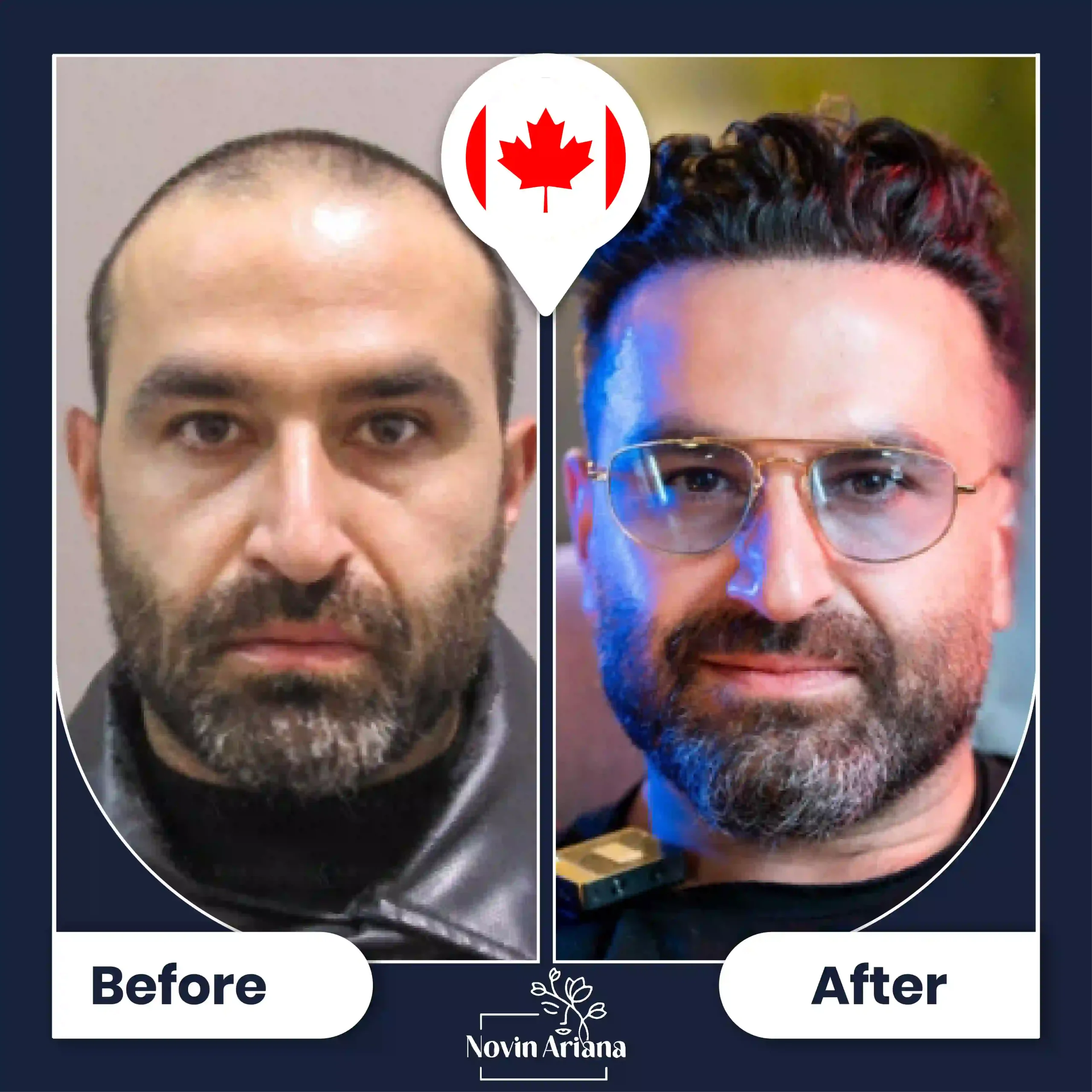 B-A-HairTransplant-43-OP