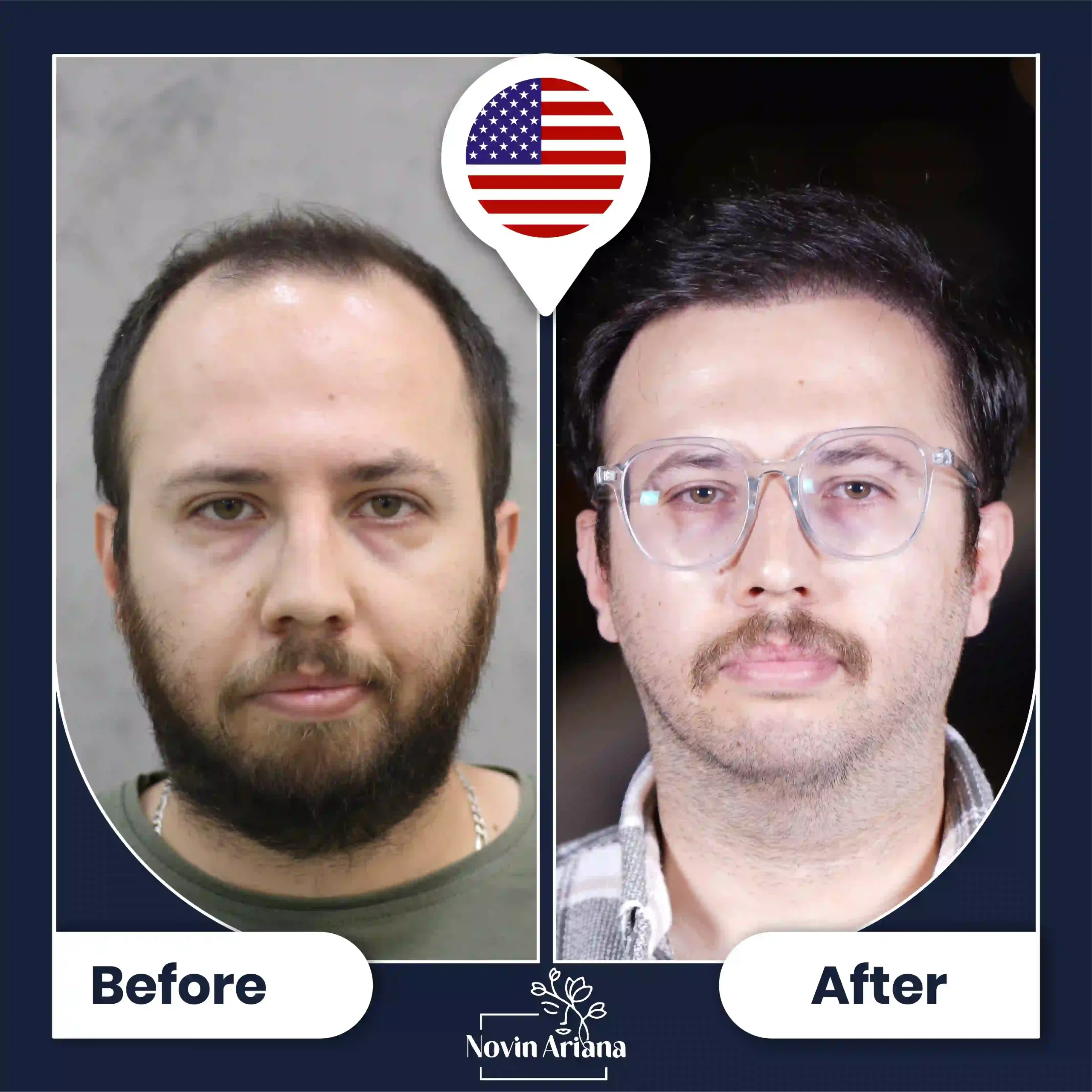 B-A-HairTransplant-46-OP
