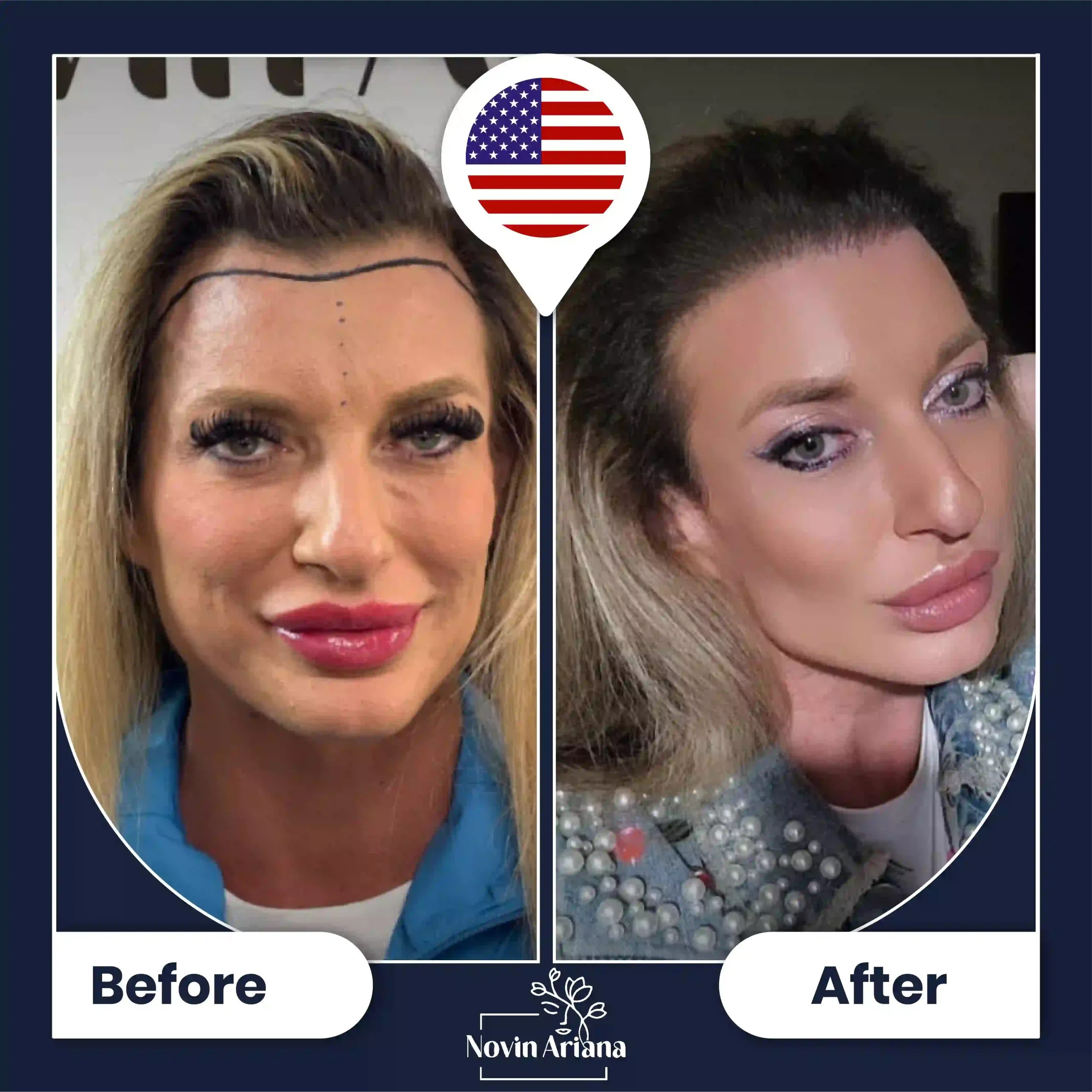 B-A-HairTransplant-47-OP
