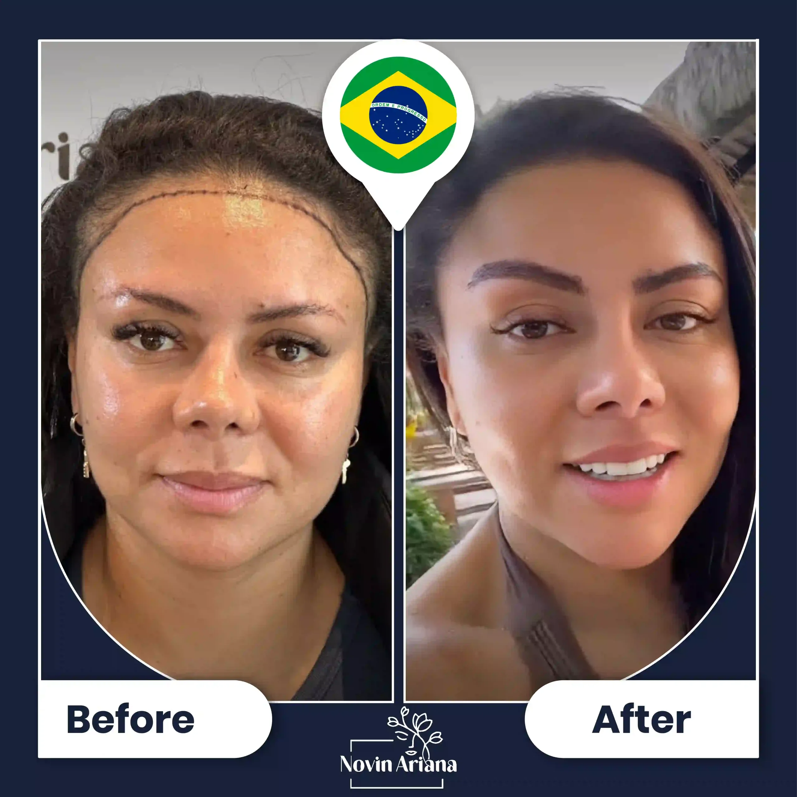 B-A-HairTransplant-48-OP