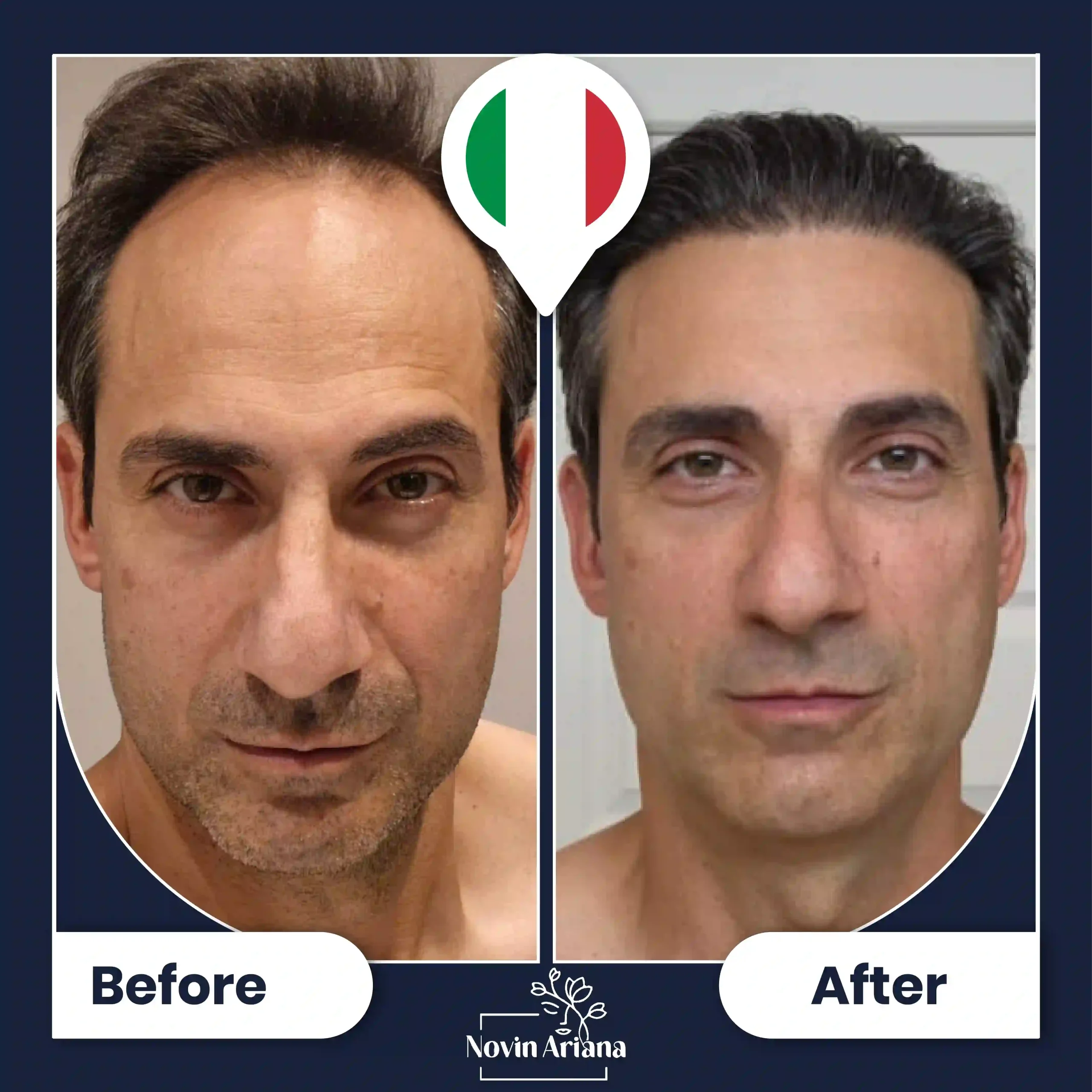 B-A-HairTransplant-49-OP