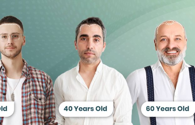 What is the best age for a hair transplant?