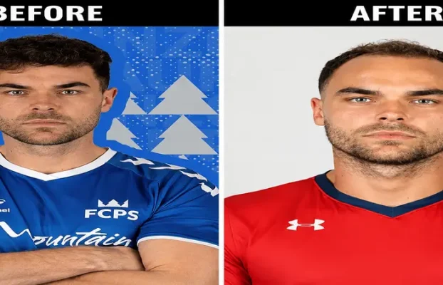 Harry Love Island Hair Transplant: The Full Story Behind His Transformation