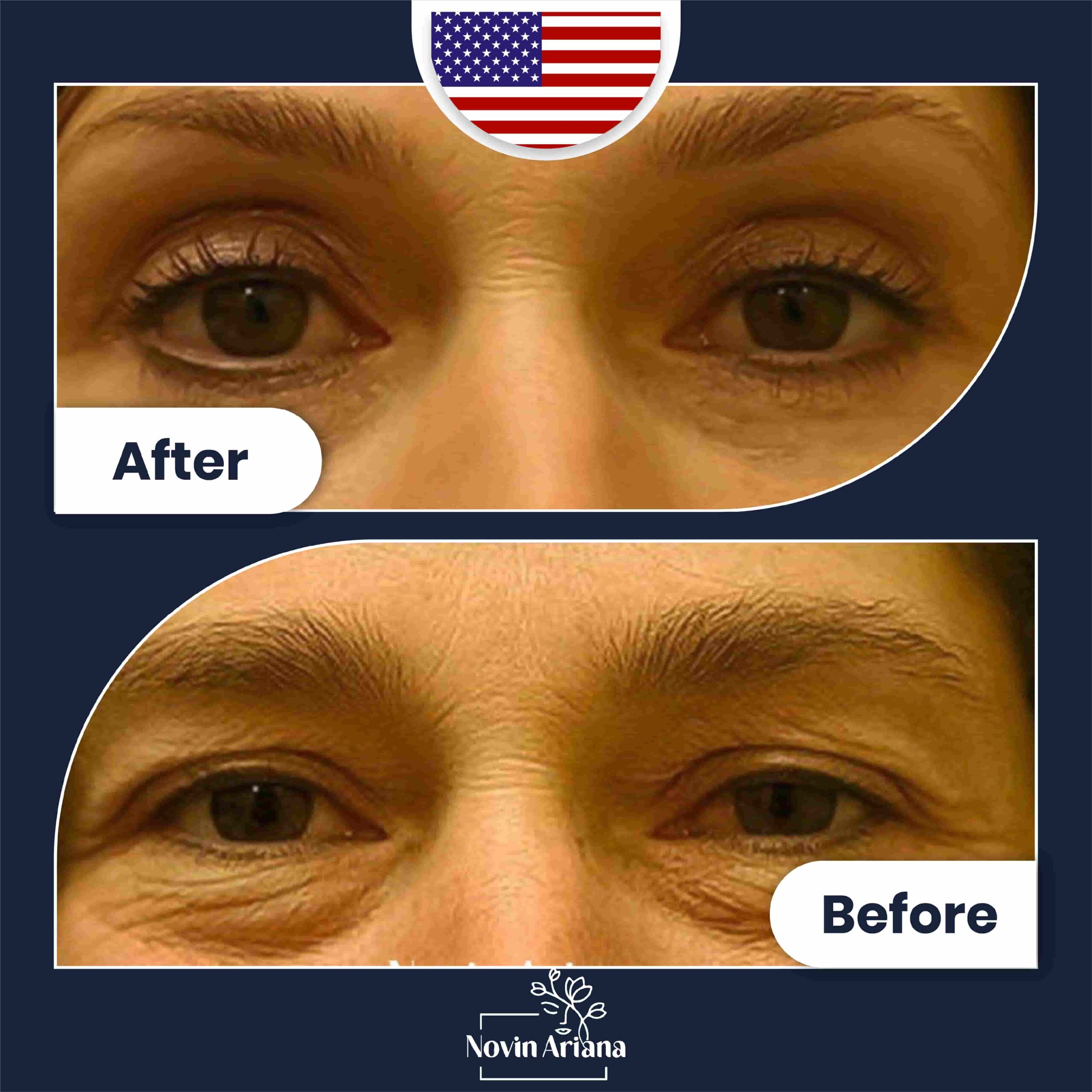 Blepharoplasty Before After (1)