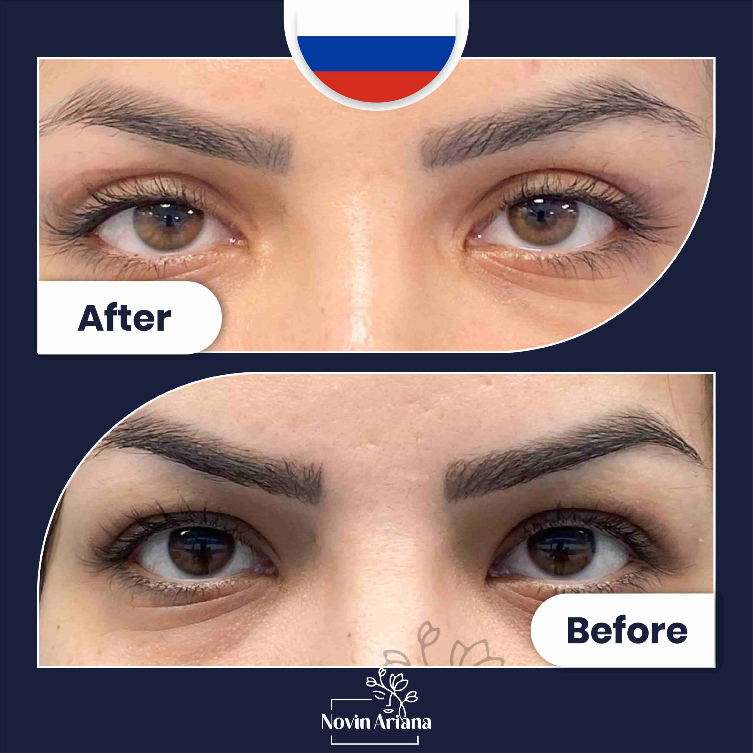 How to Travel After Cosmetic Surgery Safely