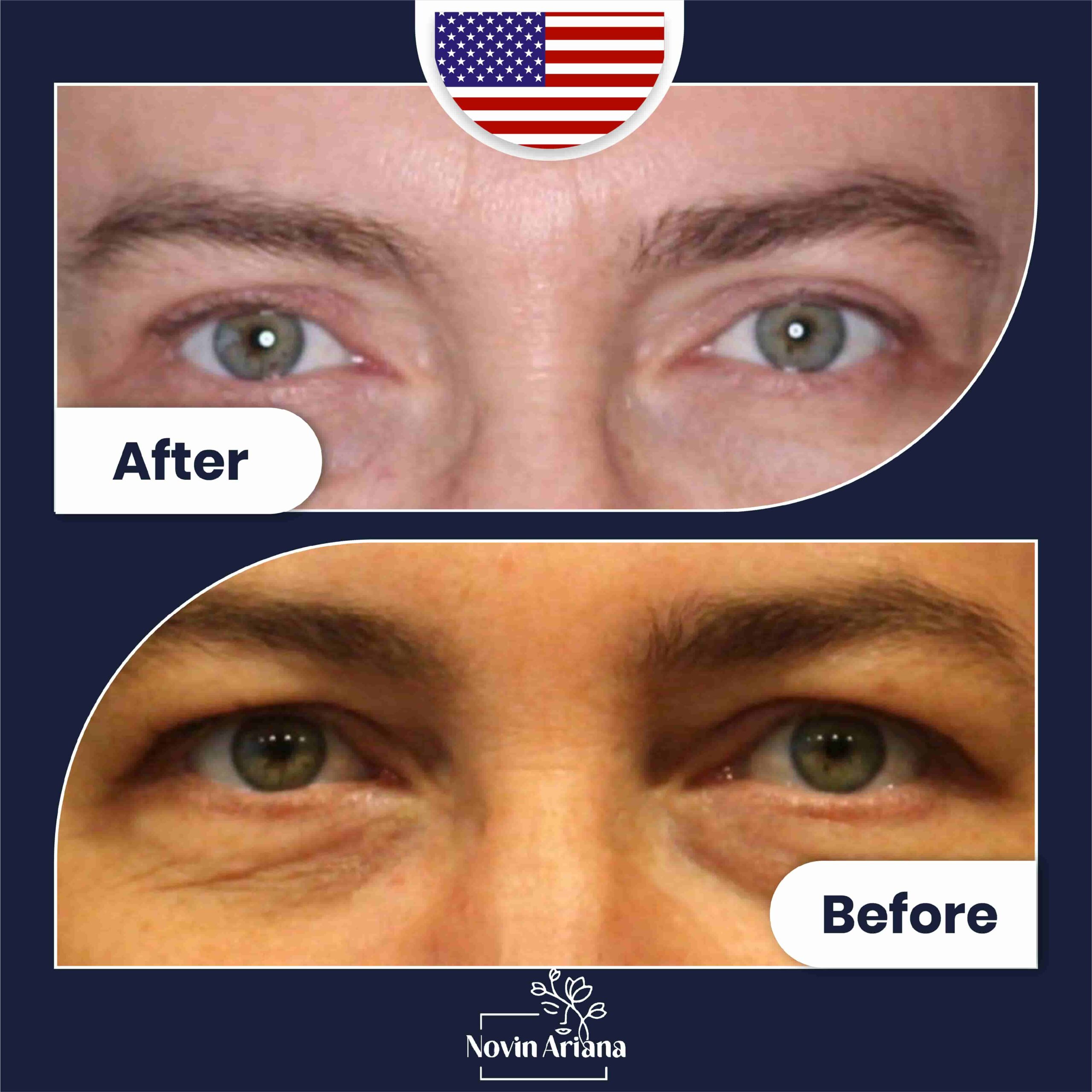 How to Travel After Cosmetic Surgery Safely