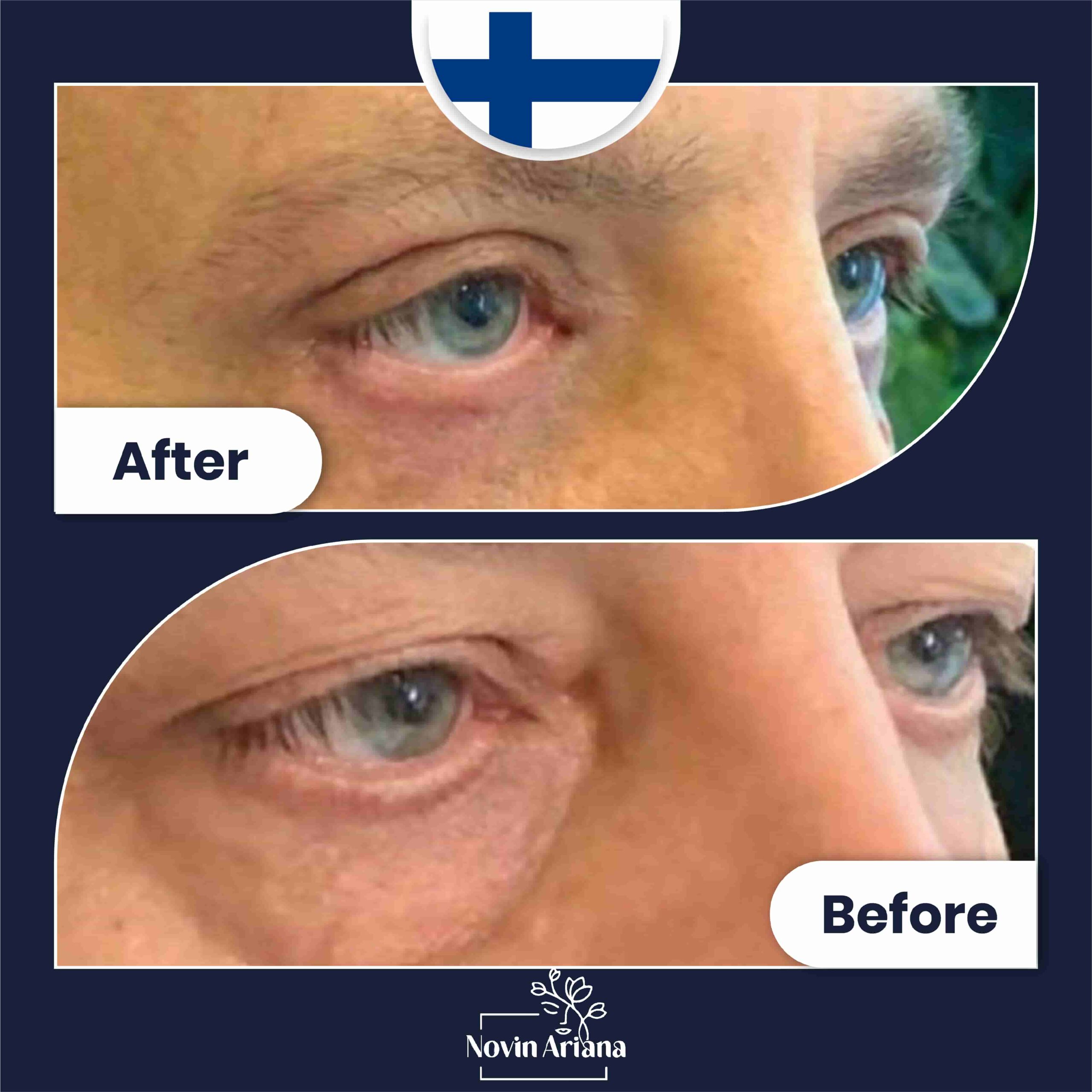 Blepharoplasty Before After (4)