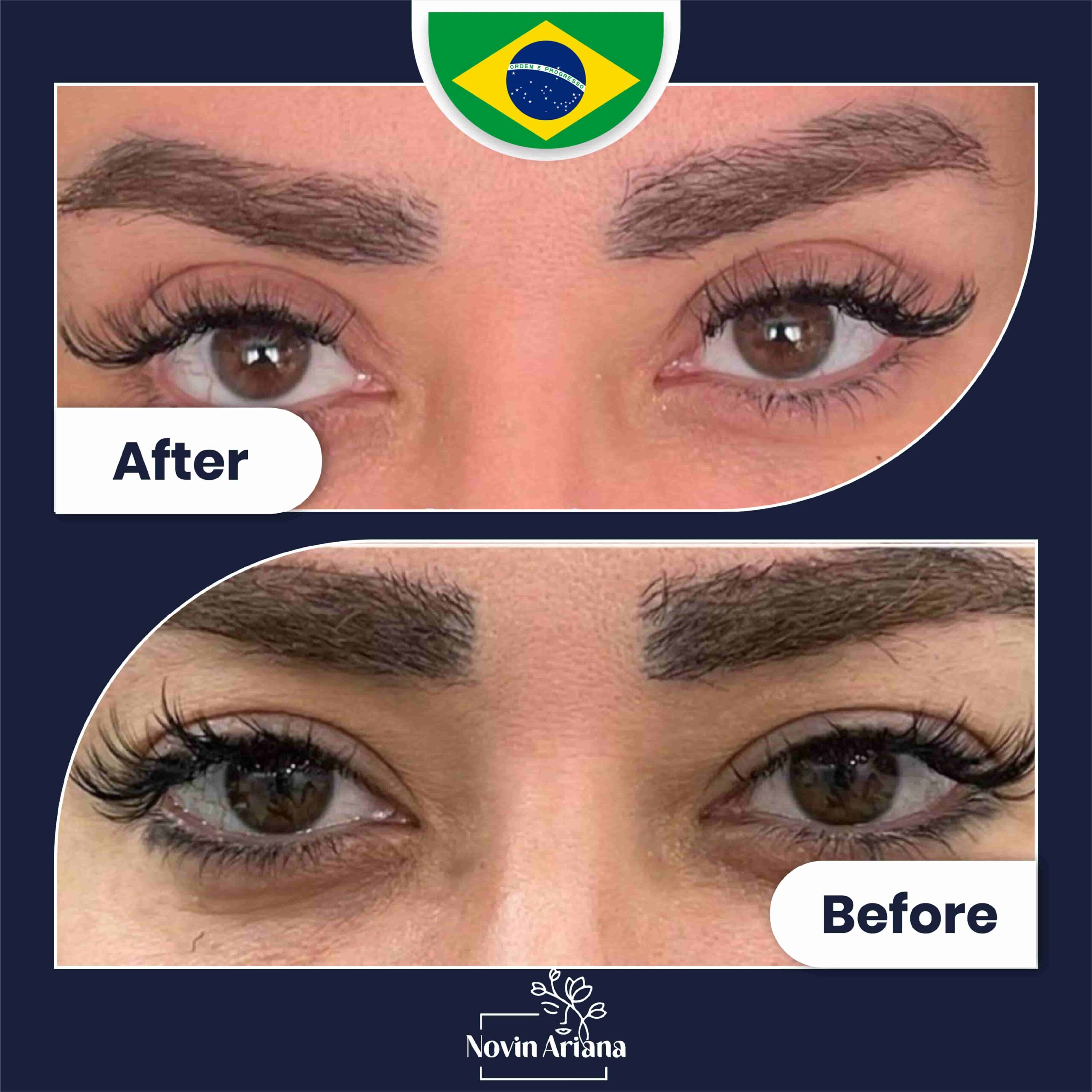 Blepharoplasty Before After (5)
