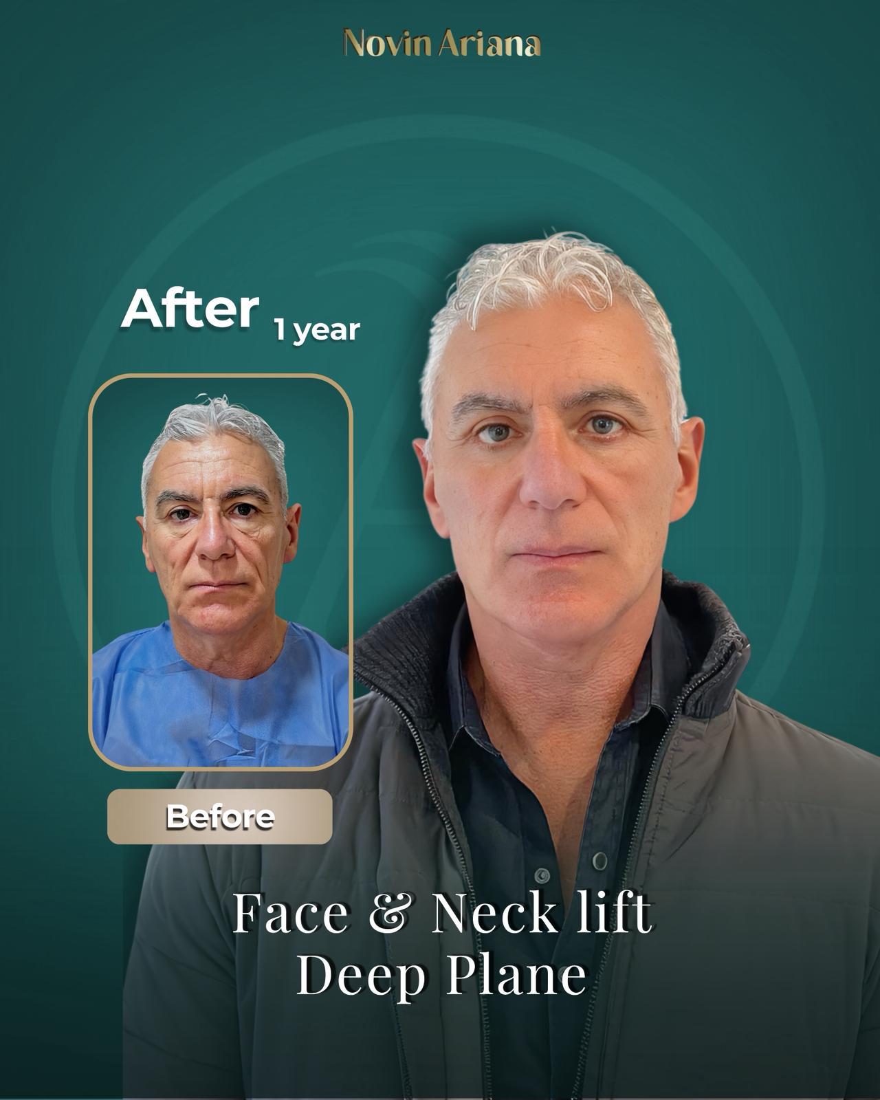 Face Lift Turkey, Facelift Turkey, Facelift Turkey Cost, Face Lift Turkey Cost, Best Facelift Surgeon in Turkey, Best Facelift Clinic in Turkey, Facelift Surgery Turkey, Facelift Istanbul Turkey, Deep Plane Facelift Turkey, Mini Facelift Turkey, Full Facelift Turkey, Face Lift Package Turkey, Facelift Turkey Before and After, Facelift Turkey Reviews, Is Facelift Turkey Safe, Facelift Recovery Turkey, How Much Does a Facelift Cost in Turkey, Turkey Facelift Packages, Facelift Holiday Turkey, Facial Rejuvenation Turkey, Neck Lift Turkey, Eyelid Surgery Turkey, Anti-Aging Surgery Turkey, Face and Neck Lift Turkey, Male Facelift Turkey, Facelift vs Fillers, Facelift Recovery Time, How Long Does Facelift Last, Facelift Scars Turkey, Facelift Consultation Turkey