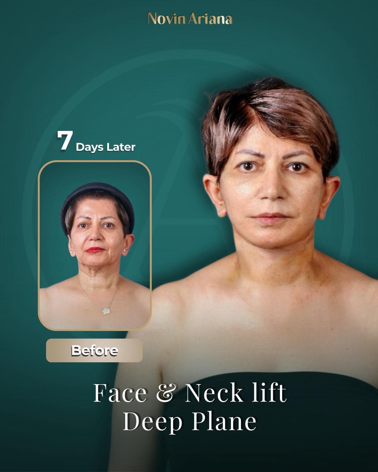 Face Lift Turkey, Facelift Turkey, Facelift Turkey Cost, Face Lift Turkey Cost, Best Facelift Surgeon in Turkey, Best Facelift Clinic in Turkey, Facelift Surgery Turkey, Facelift Istanbul Turkey, Deep Plane Facelift Turkey, Mini Facelift Turkey, Full Facelift Turkey, Face Lift Package Turkey, Facelift Turkey Before and After, Facelift Turkey Reviews, Is Facelift Turkey Safe, Facelift Recovery Turkey, How Much Does a Facelift Cost in Turkey, Turkey Facelift Packages, Facelift Holiday Turkey, Facial Rejuvenation Turkey, Neck Lift Turkey, Eyelid Surgery Turkey, Anti-Aging Surgery Turkey, Face and Neck Lift Turkey, Male Facelift Turkey, Facelift vs Fillers, Facelift Recovery Time, How Long Does Facelift Last, Facelift Scars Turkey, Facelift Consultation Turkey