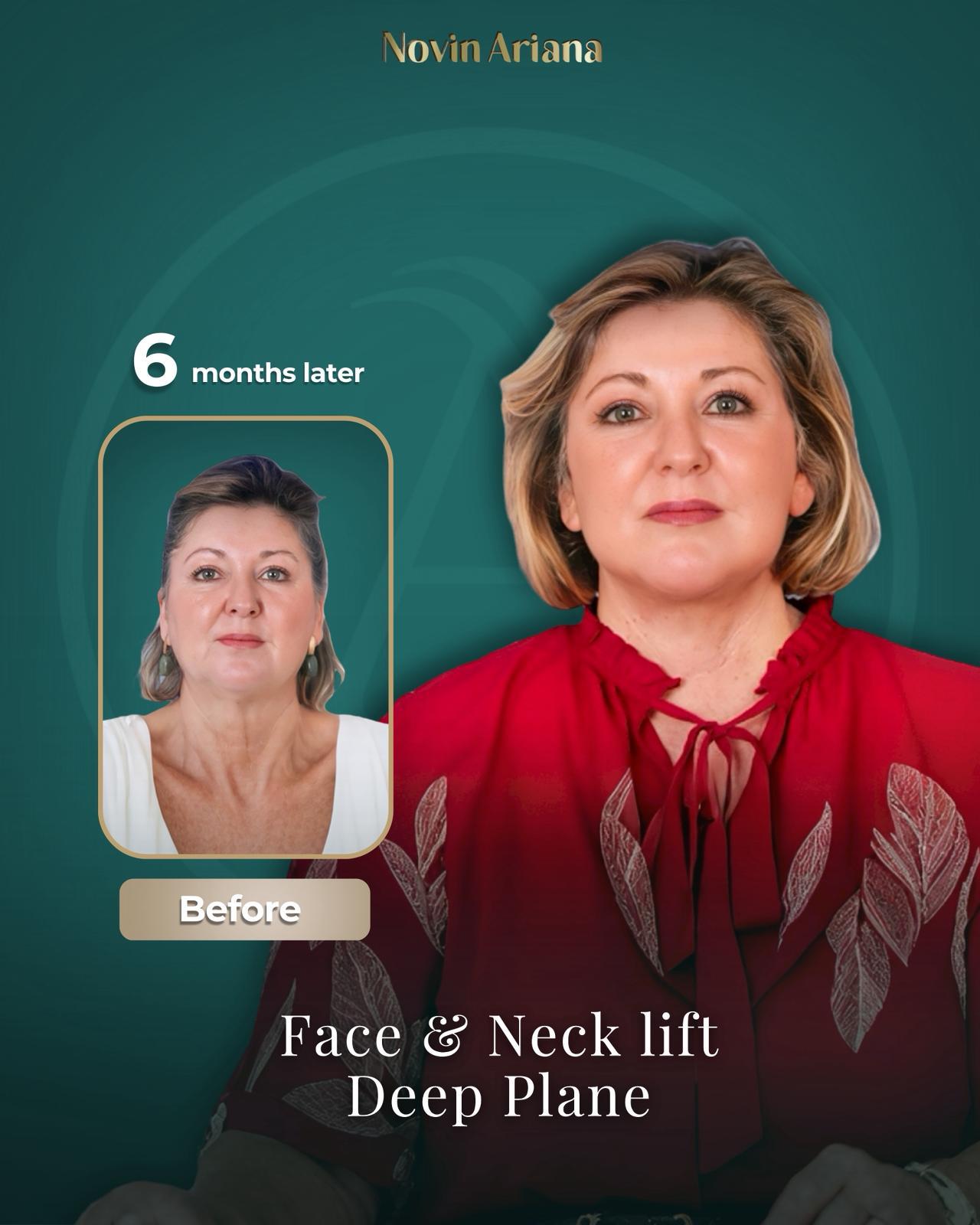 Face Lift Turkey, Facelift Turkey, Facelift Turkey Cost, Face Lift Turkey Cost, Best Facelift Surgeon in Turkey, Best Facelift Clinic in Turkey, Facelift Surgery Turkey, Facelift Istanbul Turkey, Deep Plane Facelift Turkey, Mini Facelift Turkey, Full Facelift Turkey, Face Lift Package Turkey, Facelift Turkey Before and After, Facelift Turkey Reviews, Is Facelift Turkey Safe, Facelift Recovery Turkey, How Much Does a Facelift Cost in Turkey, Turkey Facelift Packages, Facelift Holiday Turkey, Facial Rejuvenation Turkey, Neck Lift Turkey, Eyelid Surgery Turkey, Anti-Aging Surgery Turkey, Face and Neck Lift Turkey, Male Facelift Turkey, Facelift vs Fillers, Facelift Recovery Time, How Long Does Facelift Last, Facelift Scars Turkey, Facelift Consultation Turkey