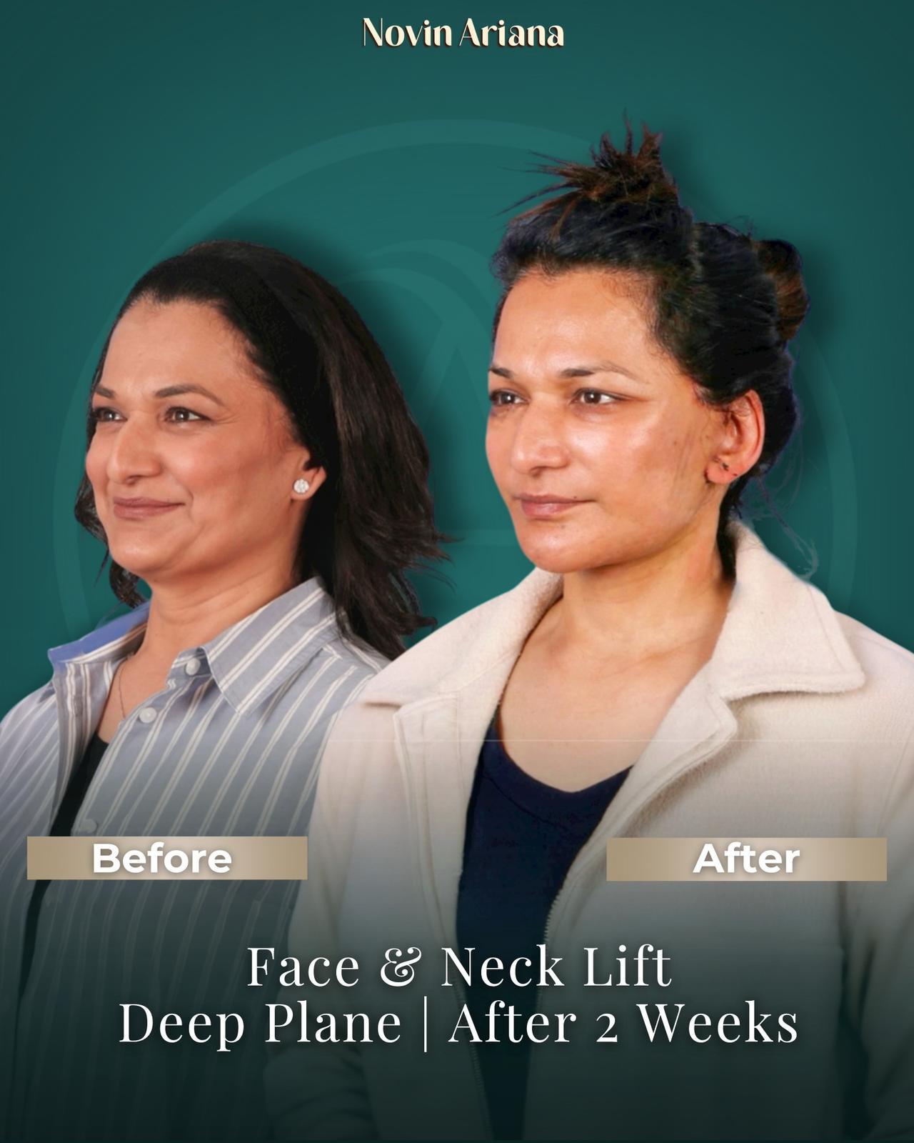Face Lift Turkey, Facelift Turkey, Facelift Turkey Cost, Face Lift Turkey Cost, Best Facelift Surgeon in Turkey, Best Facelift Clinic in Turkey, Facelift Surgery Turkey, Facelift Istanbul Turkey, Deep Plane Facelift Turkey, Mini Facelift Turkey, Full Facelift Turkey, Face Lift Package Turkey, Facelift Turkey Before and After, Facelift Turkey Reviews, Is Facelift Turkey Safe, Facelift Recovery Turkey, How Much Does a Facelift Cost in Turkey, Turkey Facelift Packages, Facelift Holiday Turkey, Facial Rejuvenation Turkey, Neck Lift Turkey, Eyelid Surgery Turkey, Anti-Aging Surgery Turkey, Face and Neck Lift Turkey, Male Facelift Turkey, Facelift vs Fillers, Facelift Recovery Time, How Long Does Facelift Last, Facelift Scars Turkey, Facelift Consultation Turkey