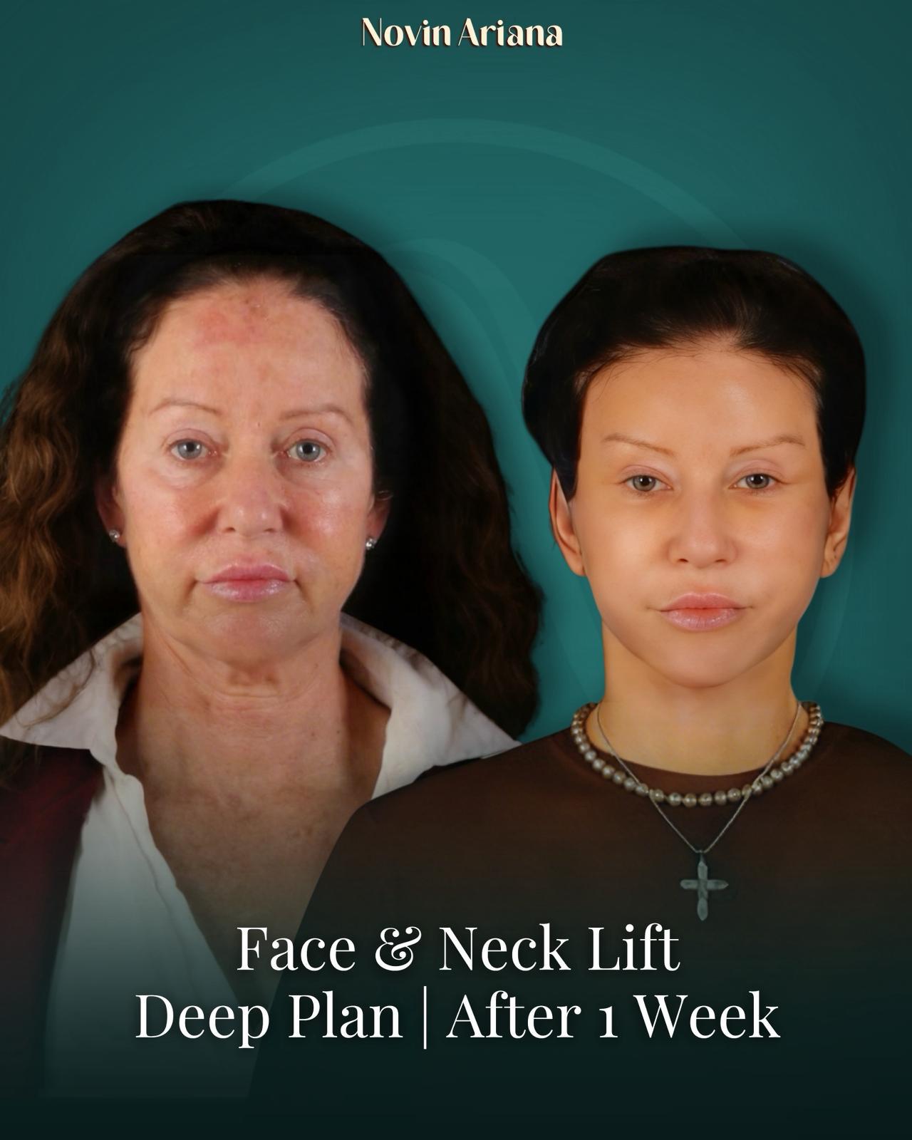 Face Lift Turkey Cost,Face Lift Turkey, Facelift Turkey, Facelift Turkey Cost, Face Lift Turkey Cost, Best Facelift Surgeon in Turkey, Best Facelift Clinic in Turkey, Facelift Surgery Turkey, Facelift Istanbul Turkey, Deep Plane Facelift Turkey, Mini Facelift Turkey, Full Facelift Turkey, Face Lift Package Turkey, Facelift Turkey Before and After, Facelift Turkey Reviews, Is Facelift Turkey Safe, Facelift Recovery Turkey, How Much Does a Facelift Cost in Turkey, Turkey Facelift Packages, Facelift Holiday Turkey, Facial Rejuvenation Turkey, Neck Lift Turkey, Eyelid Surgery Turkey, Anti-Aging Surgery Turkey, Face and Neck Lift Turkey, Male Facelift Turkey, Facelift vs Fillers, Facelift Recovery Time, How Long Does Facelift Last, Facelift Scars Turkey, Facelift Consultation Turkey