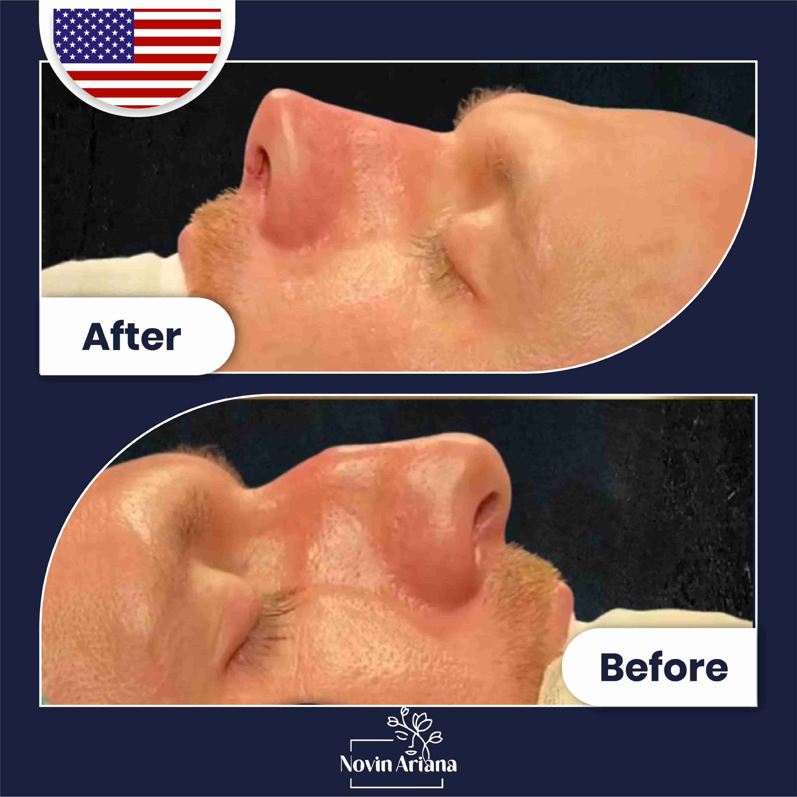 Nose job before after (1)