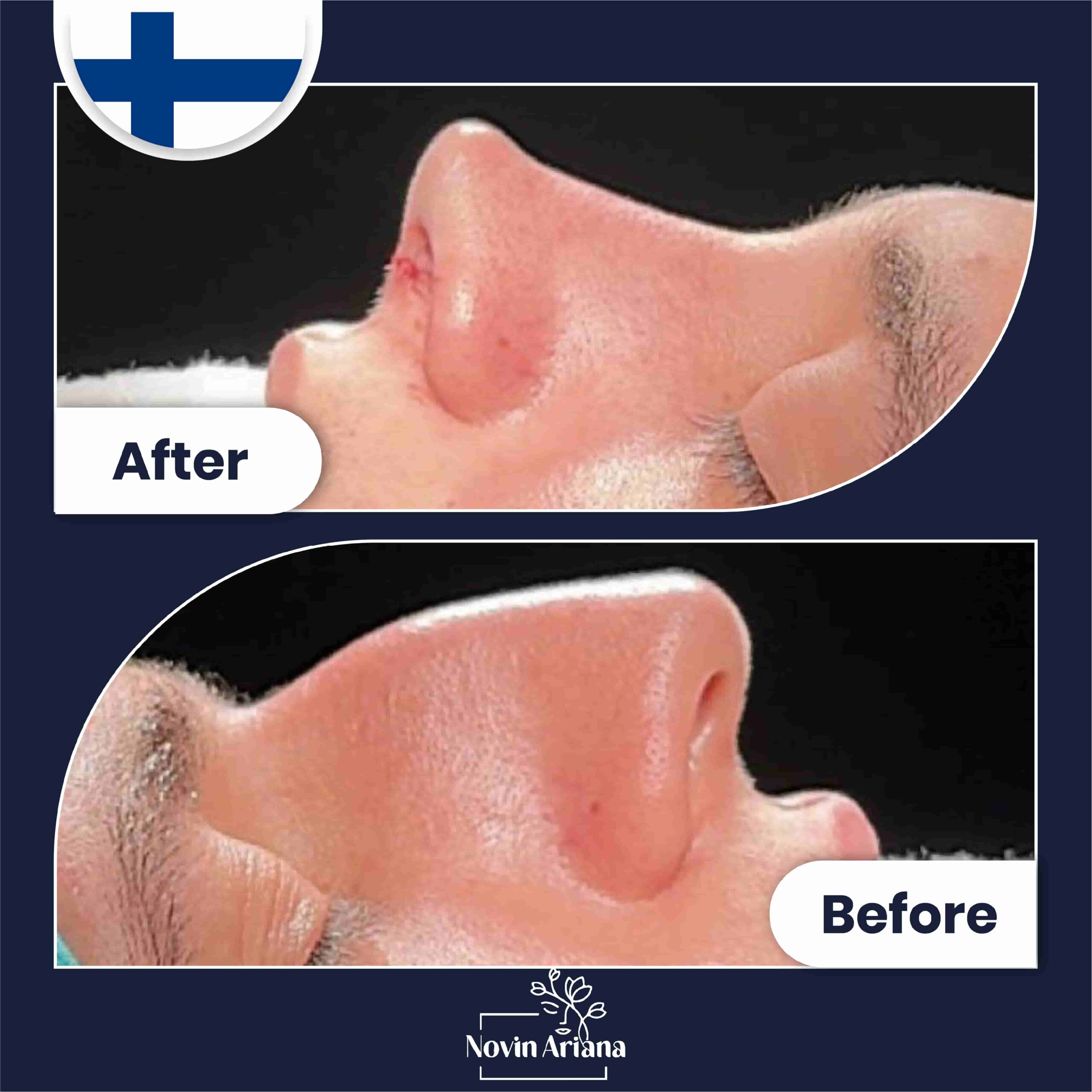 Nose job before after (2)