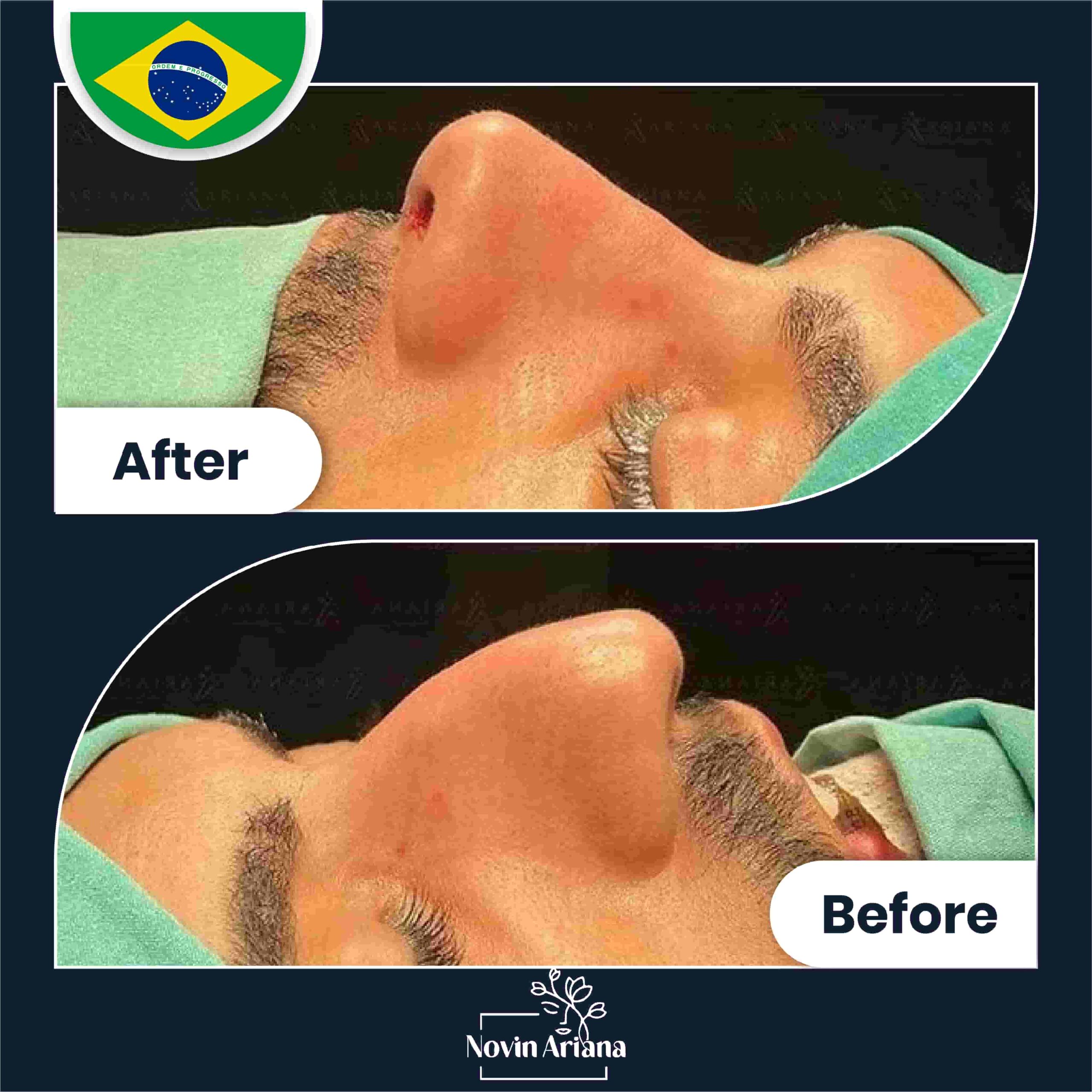 Nose job before after (4)