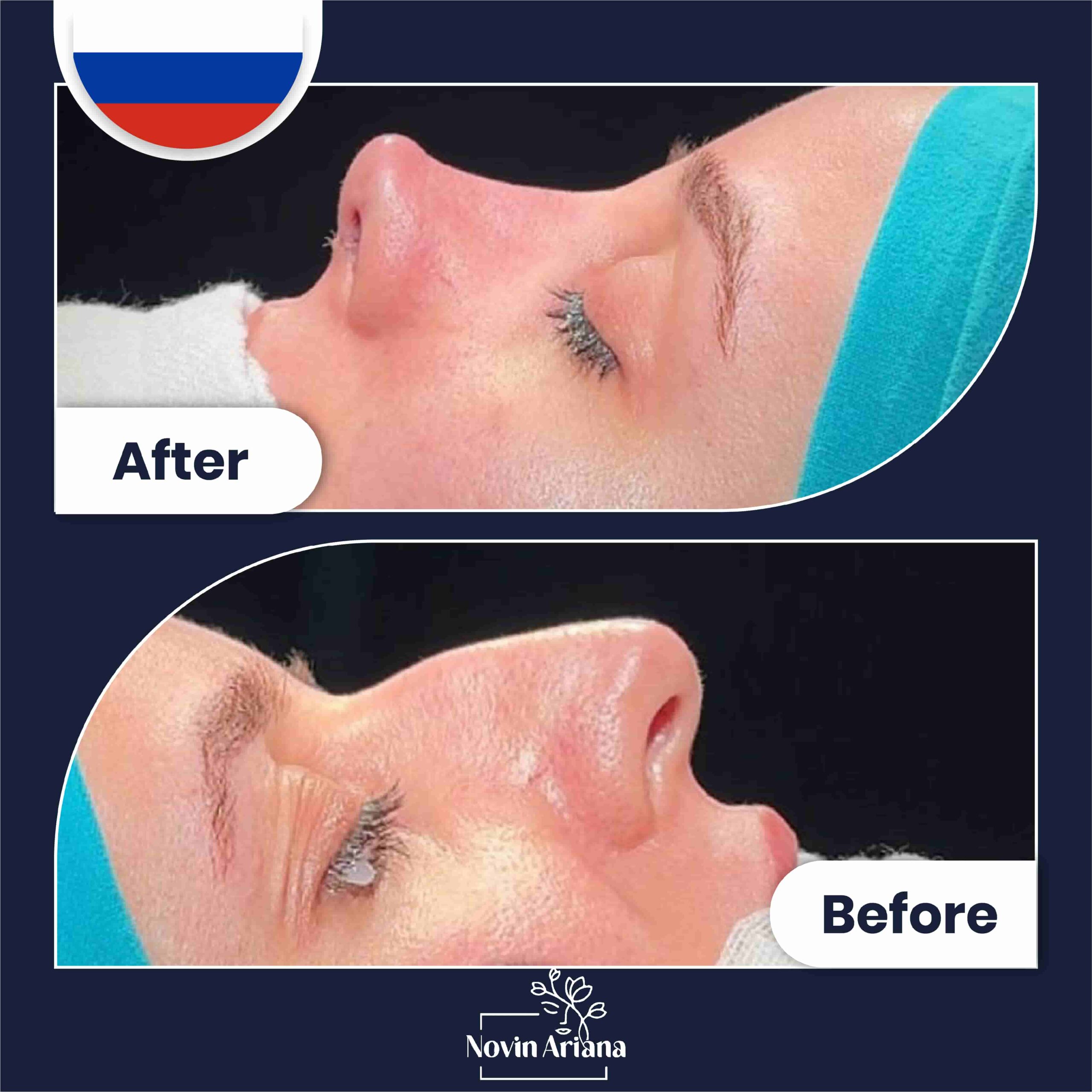 Nose job before after (5)