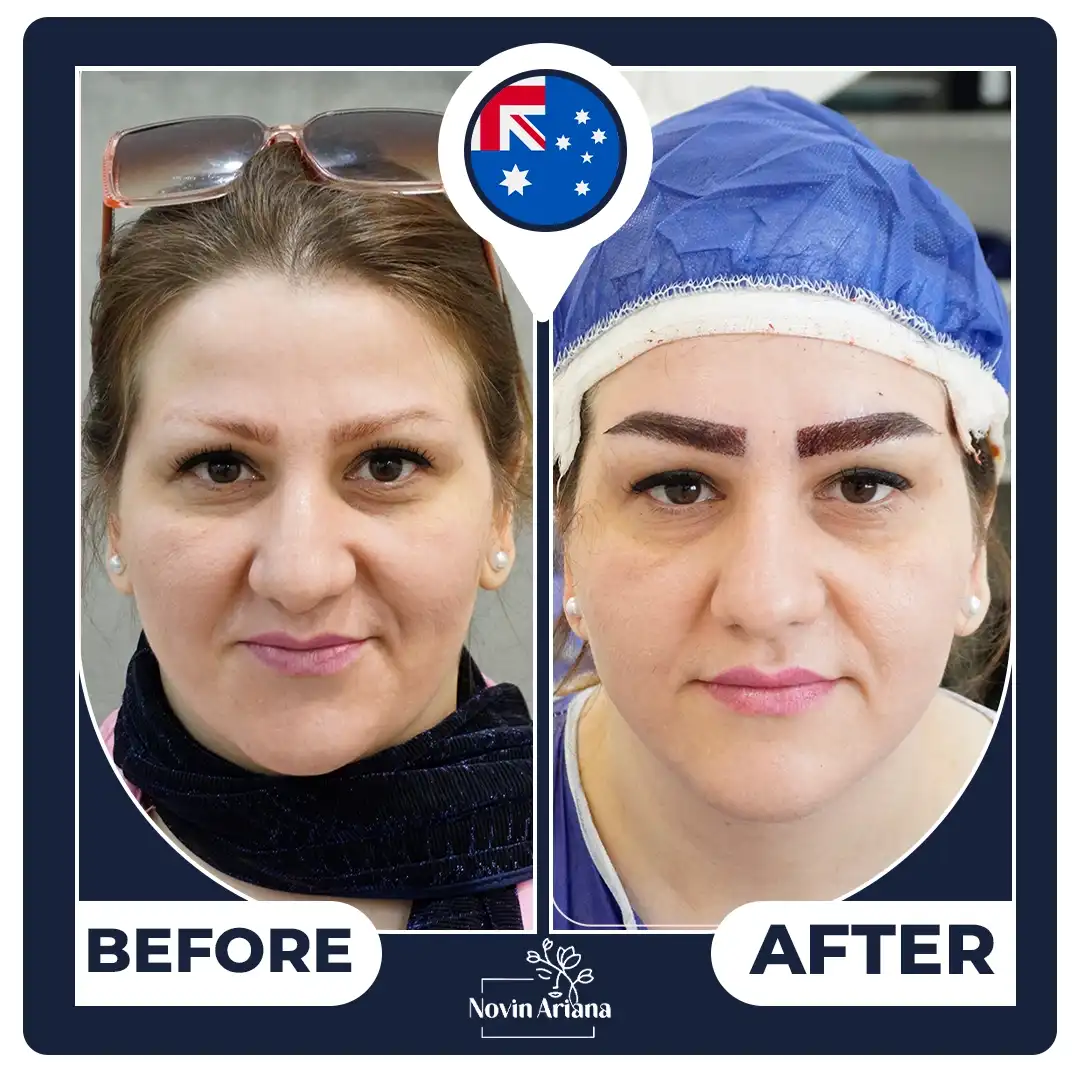Eyebrow Transplant