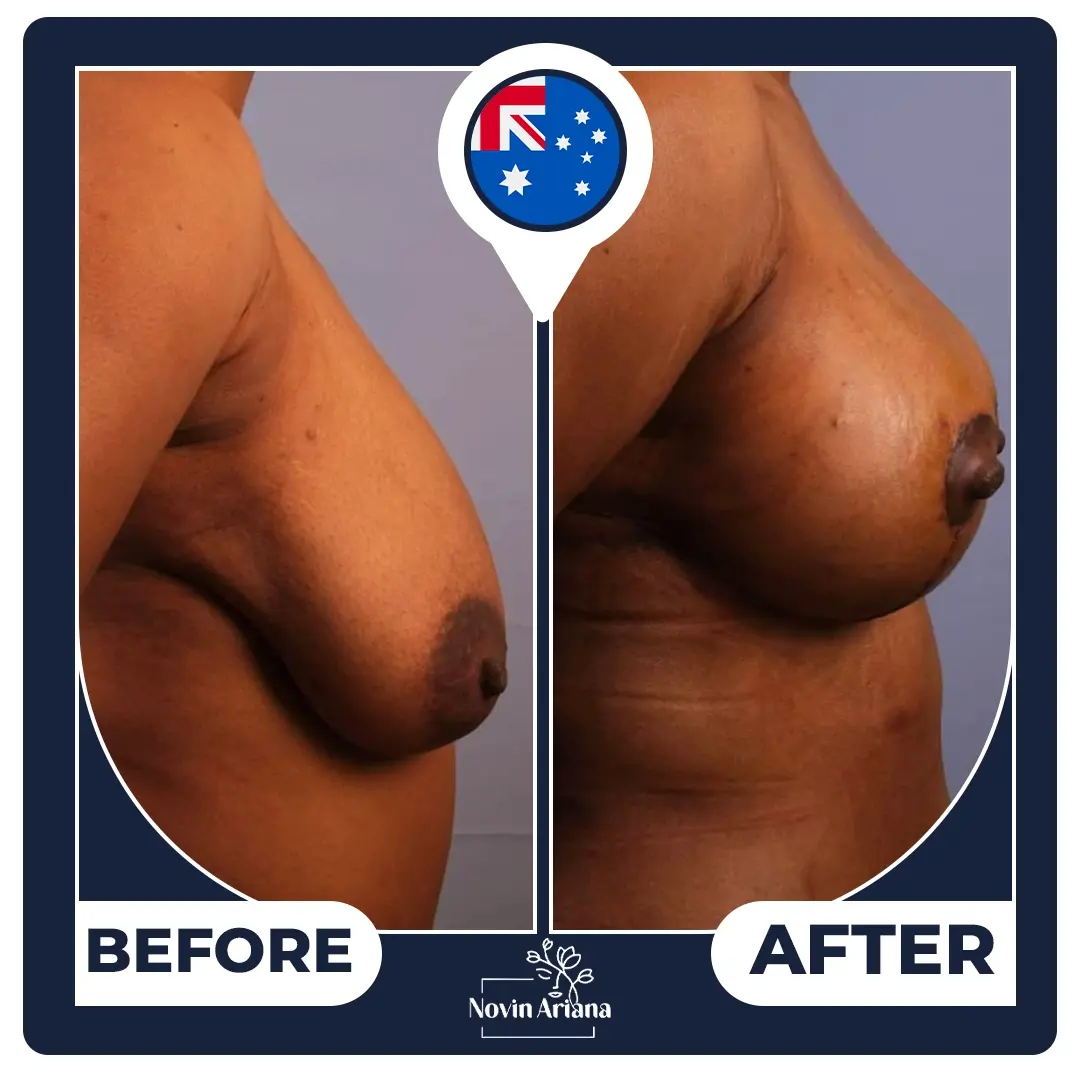 breast lift Turkey