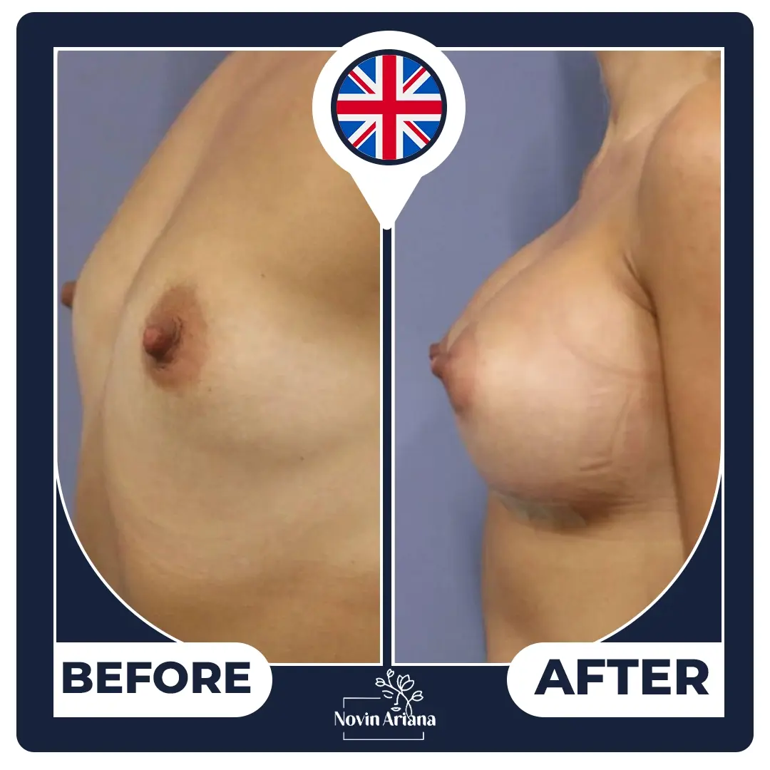 breast lift Turkey