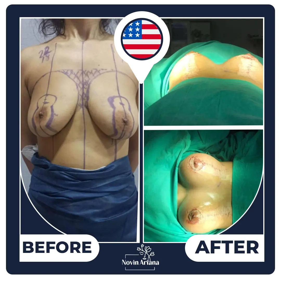 breast lift Turkey