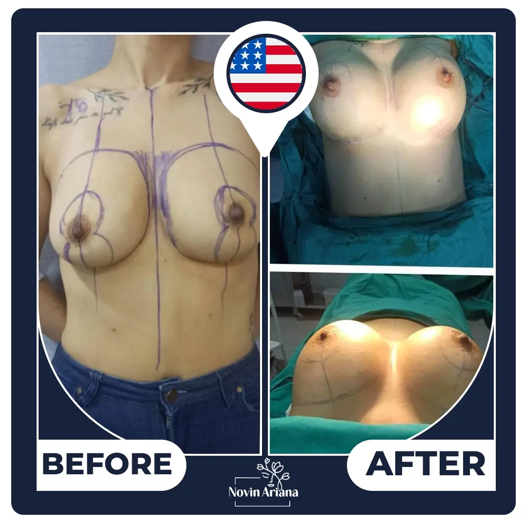 breast lift Turkey
