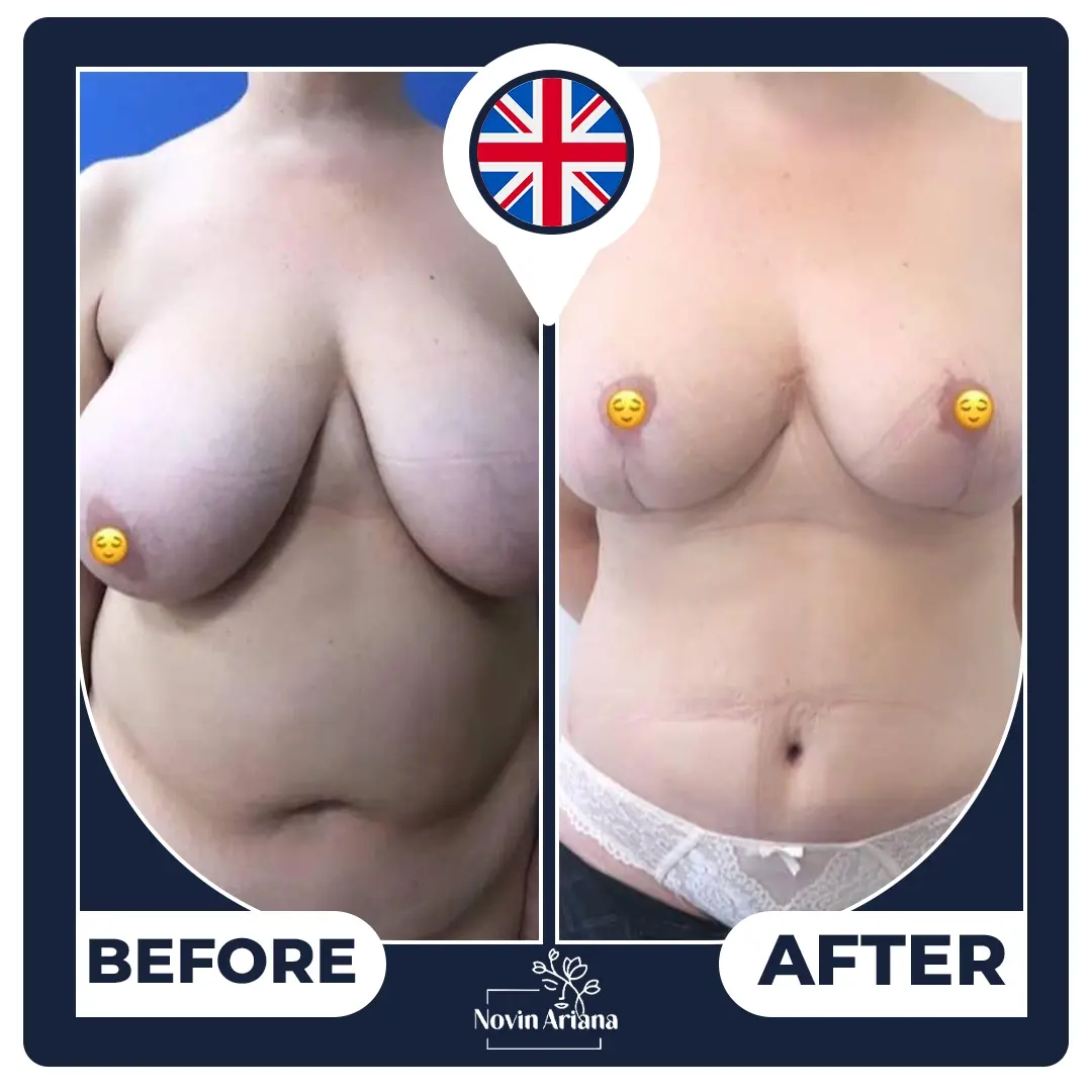 breast lift Turkey