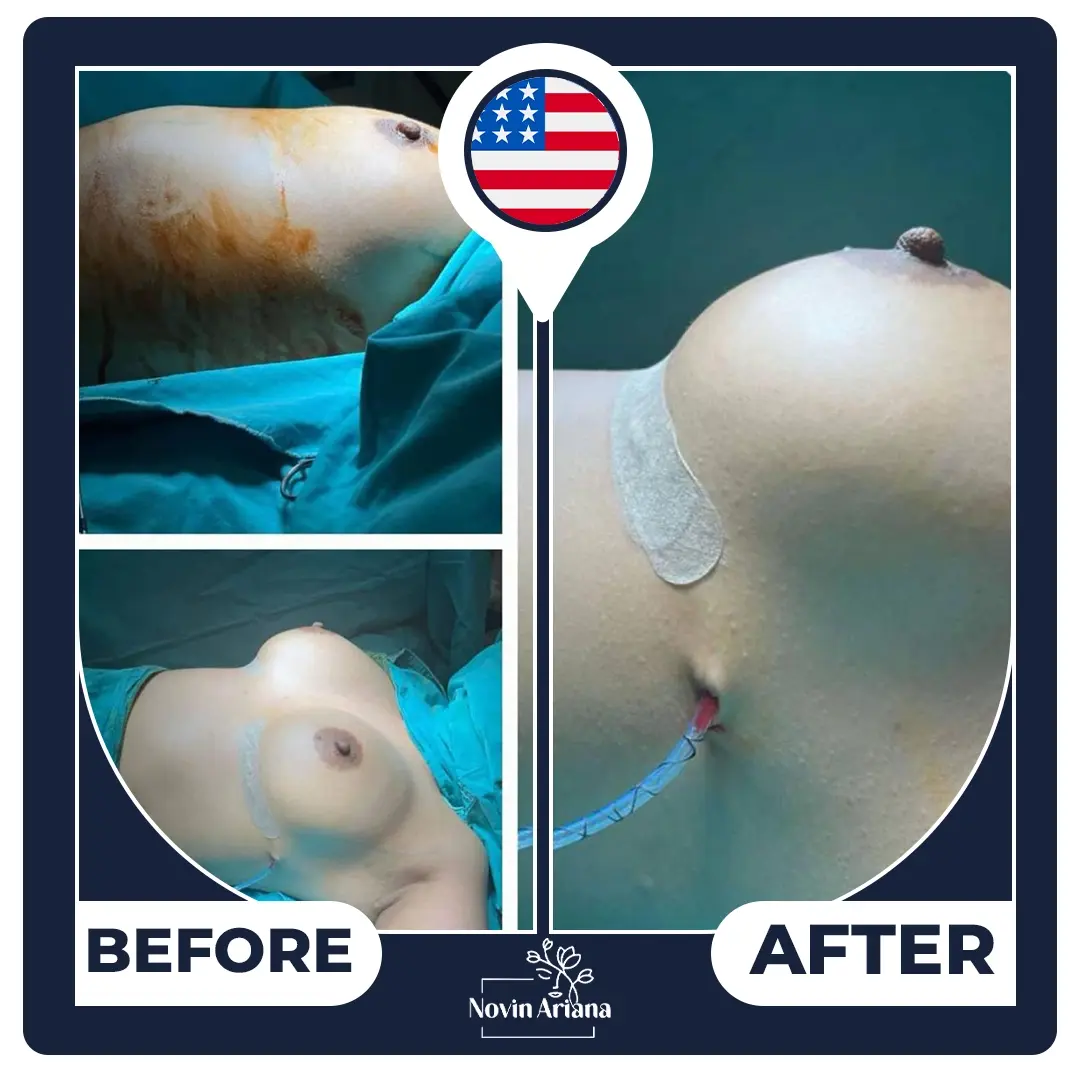 breast lift Turkey