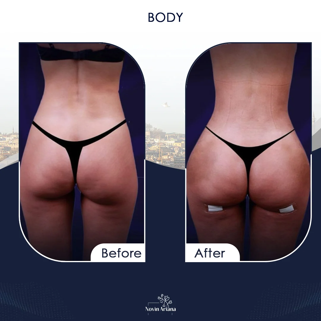 BODY1 4