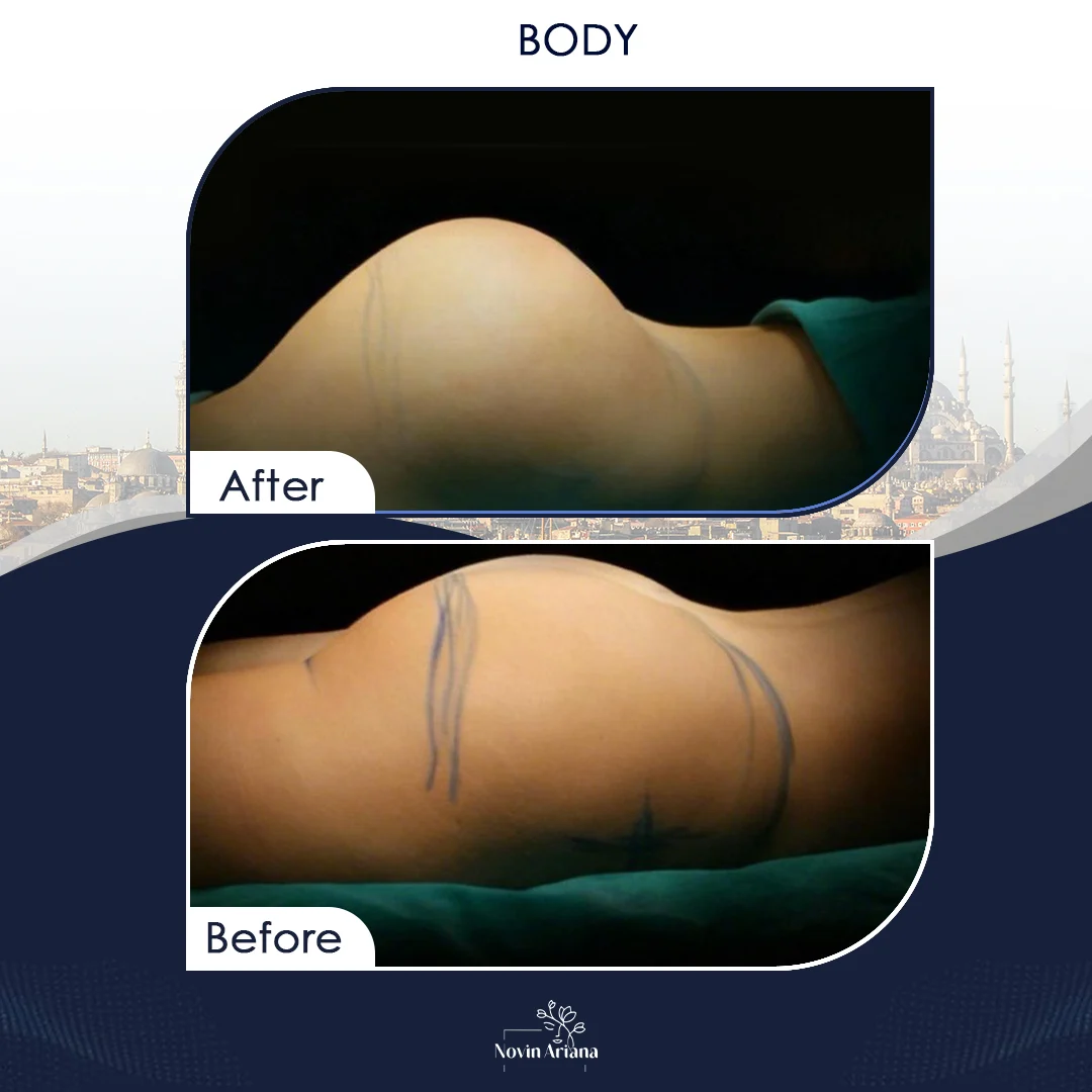 BODY10 1