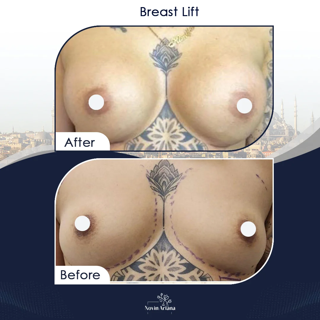 LIFT 2
