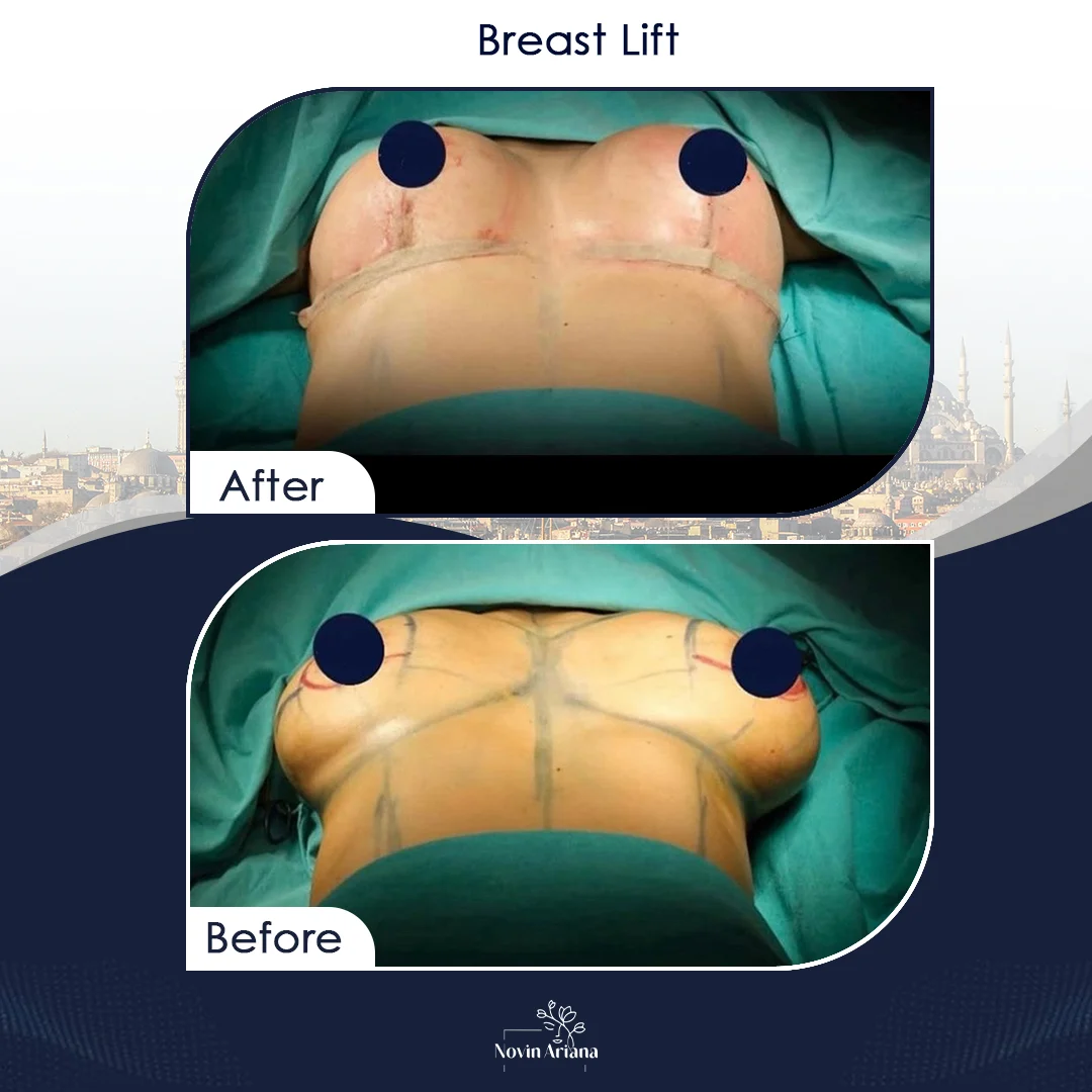 LIFT 4