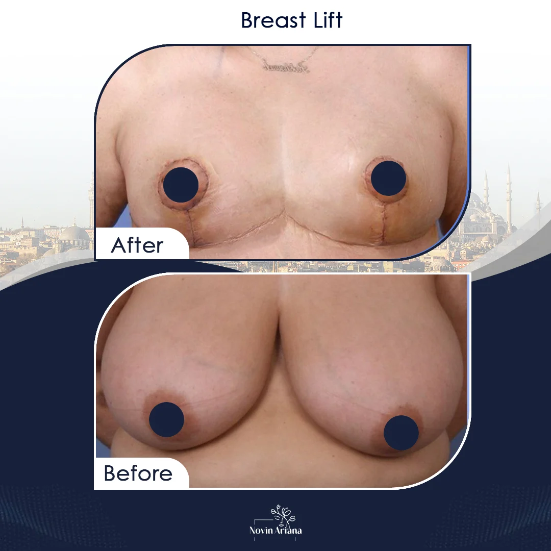 LIFT 5