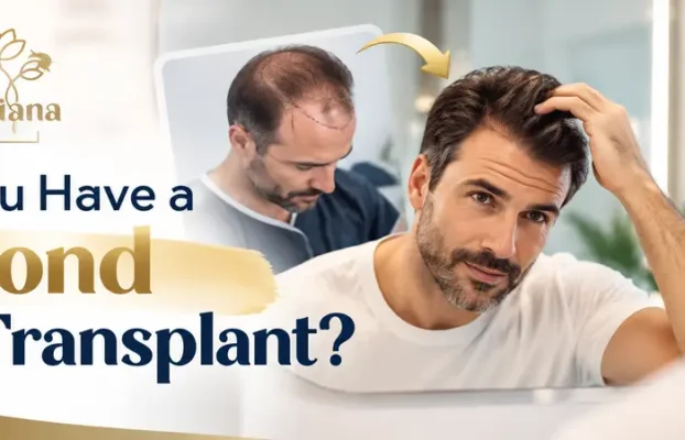 Can You Have a Second Hair Transplant?