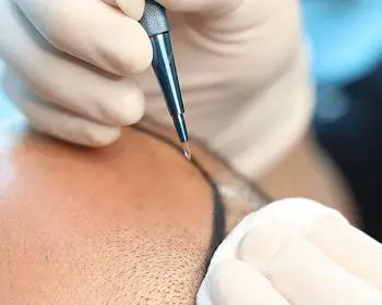 Hair Transplant in Turkey