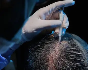 Hair Transplant in Turkey