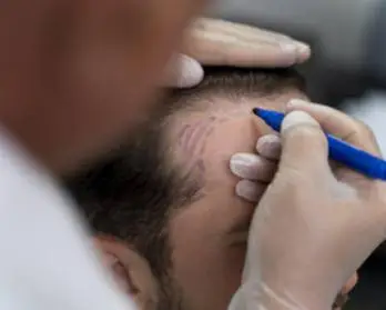 The best Hair Transplant Clinic in Turkey